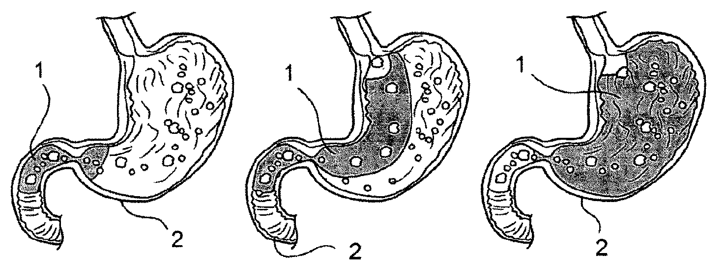 An endoluminal lining and a method for endoluminally lining a hollow organ