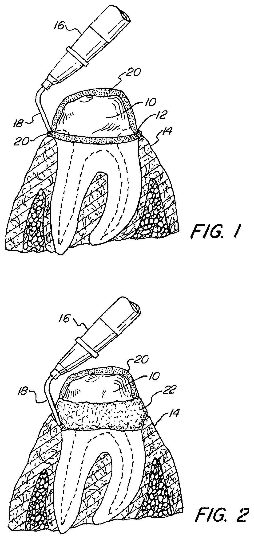 One step gingiva retraction and impression material and method
