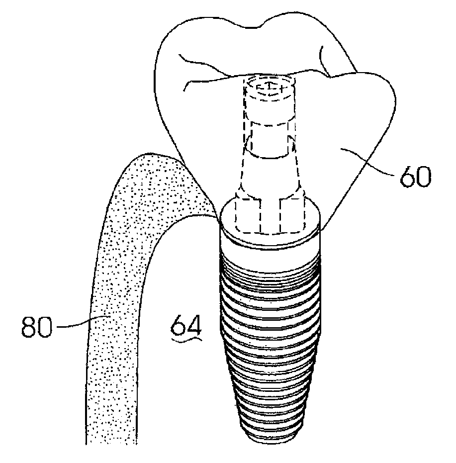 Dental implant adaptor