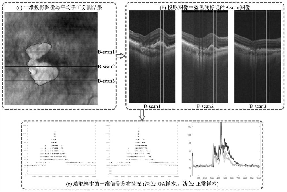 Segmentation method of GA lesion in sd-oct image based on deep voting model