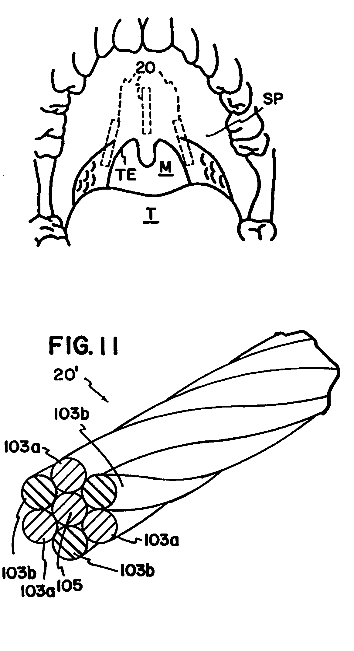 Method and apparatus to treat conditions of the naso-pharyngeal area