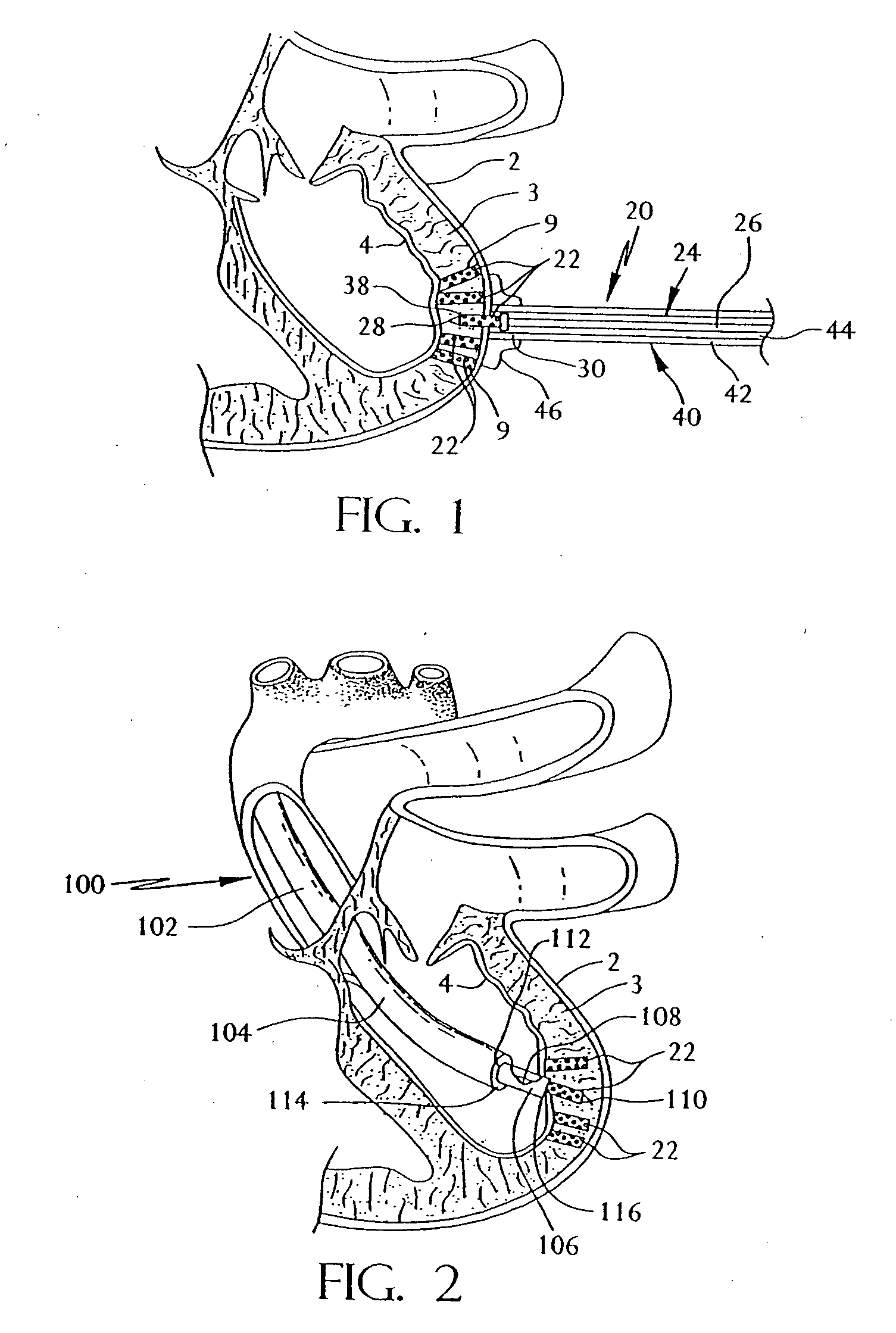 Transmyocardial revascularization system and method of use