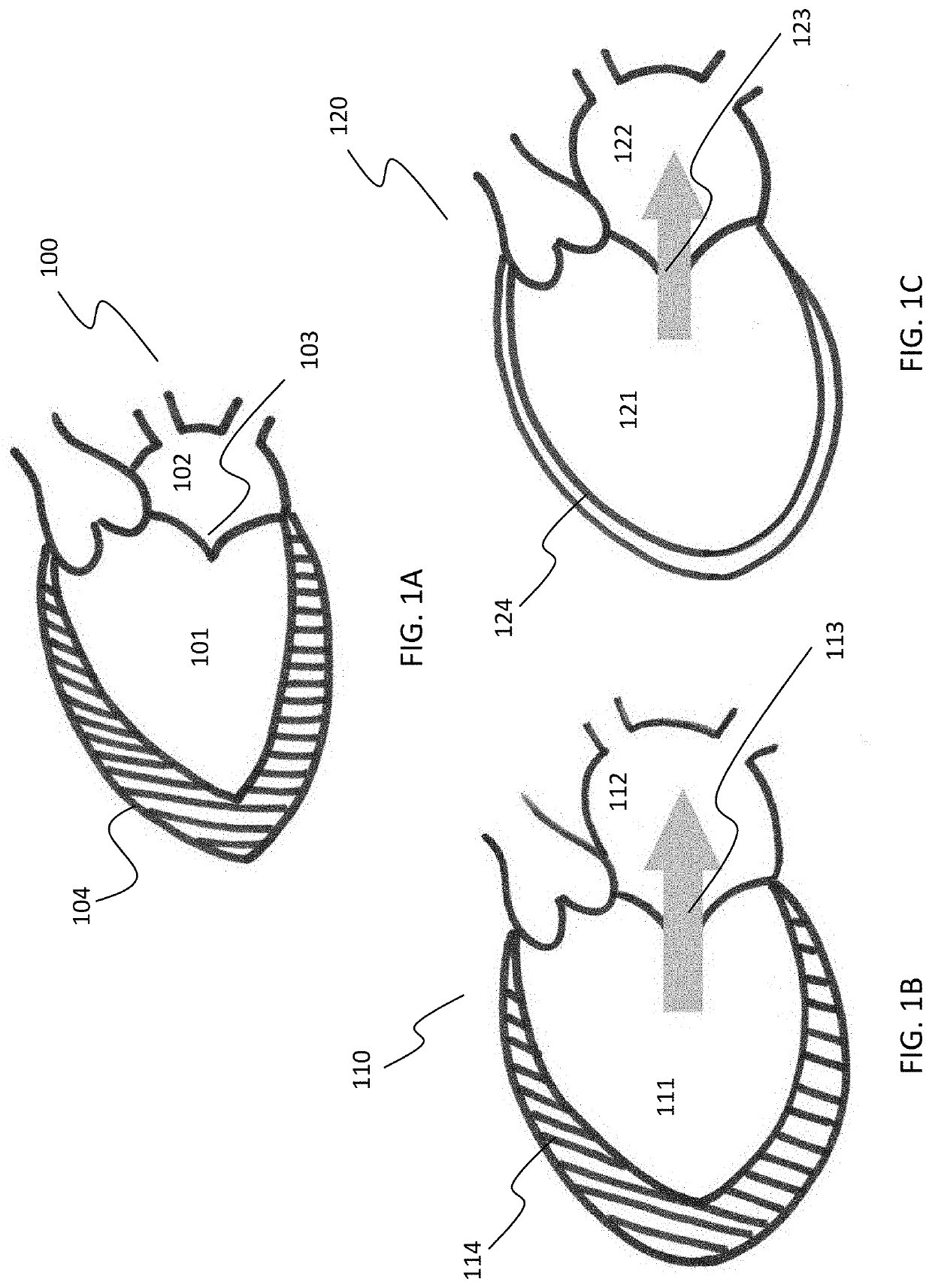 Septal-pericardial heart valve implant anchor