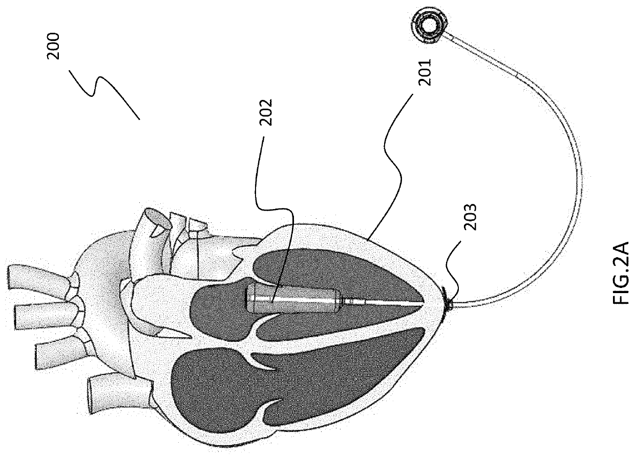 Septal-pericardial heart valve implant anchor