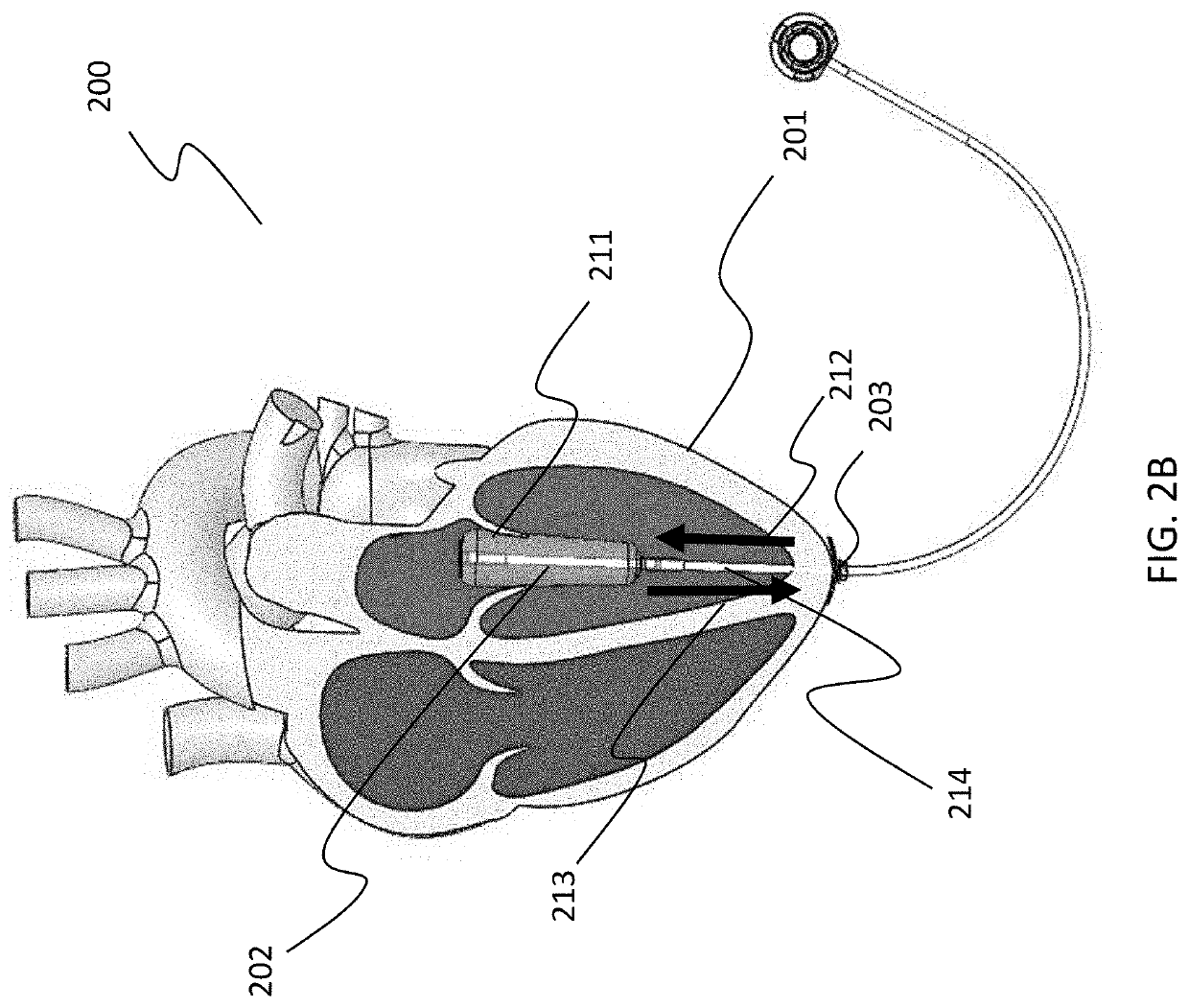 Septal-pericardial heart valve implant anchor