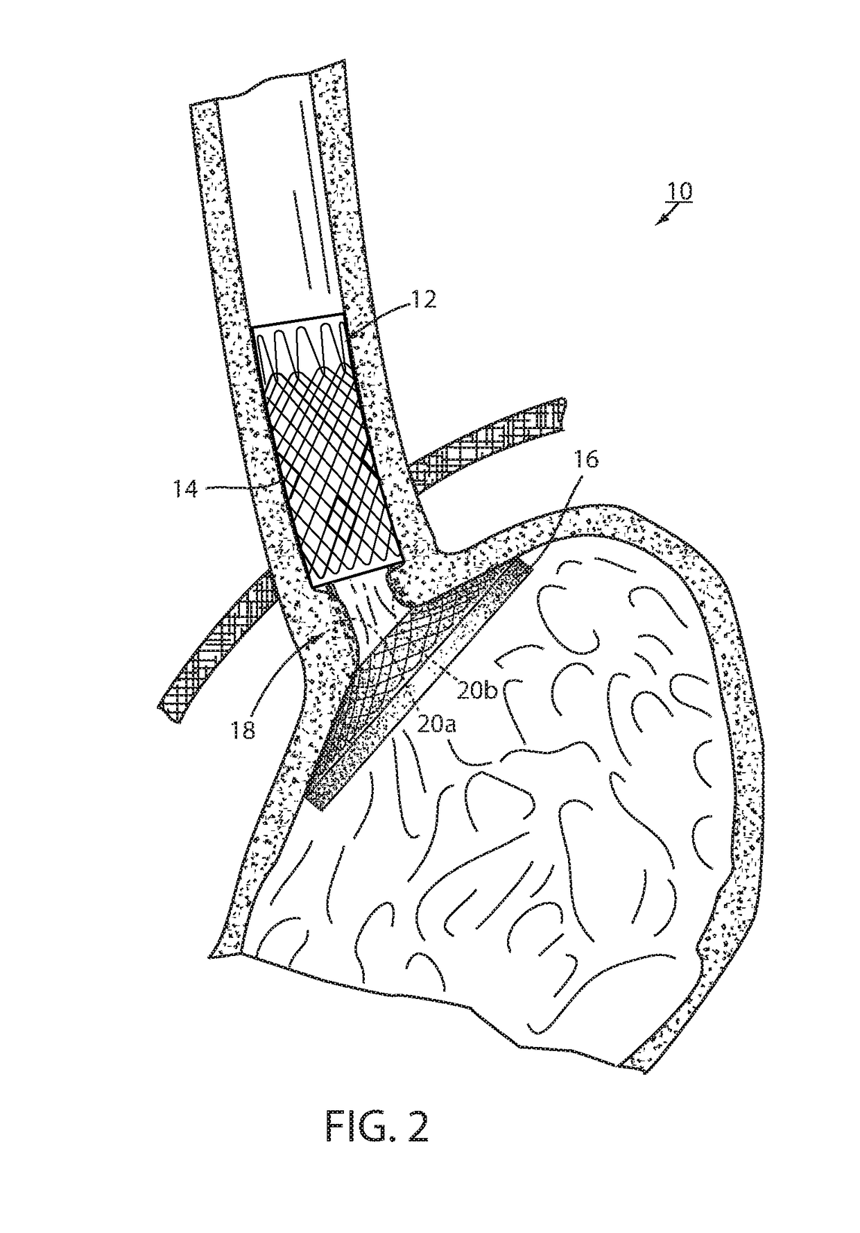 Fixation of intraluminal device