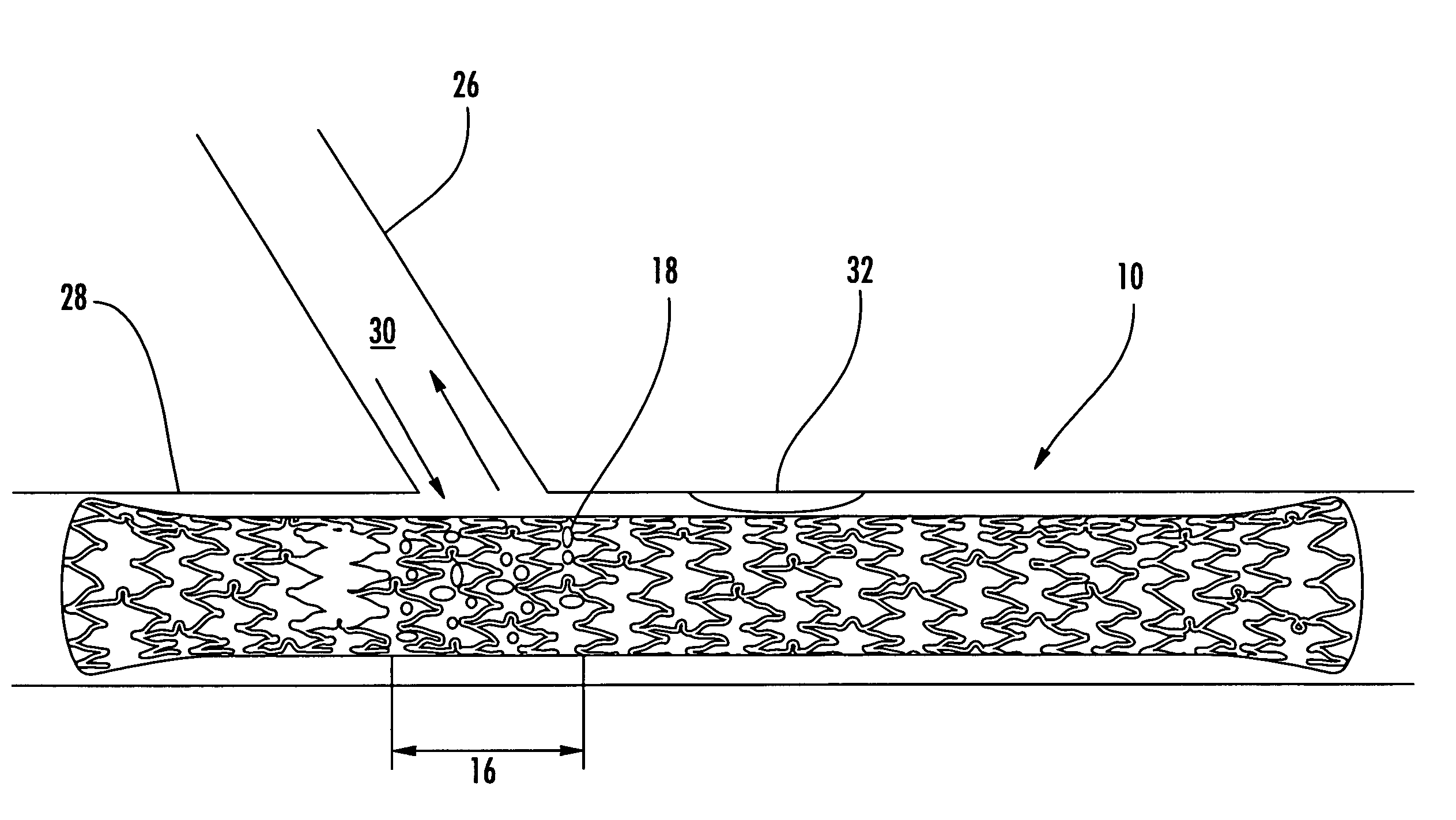 Drainage stent and associated method