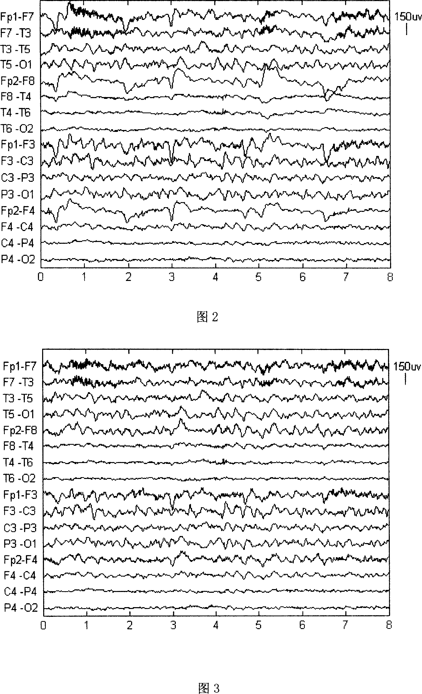 Method for automatically recogniting and eliminating ophthalmogyric interference in electroencephalo-signals