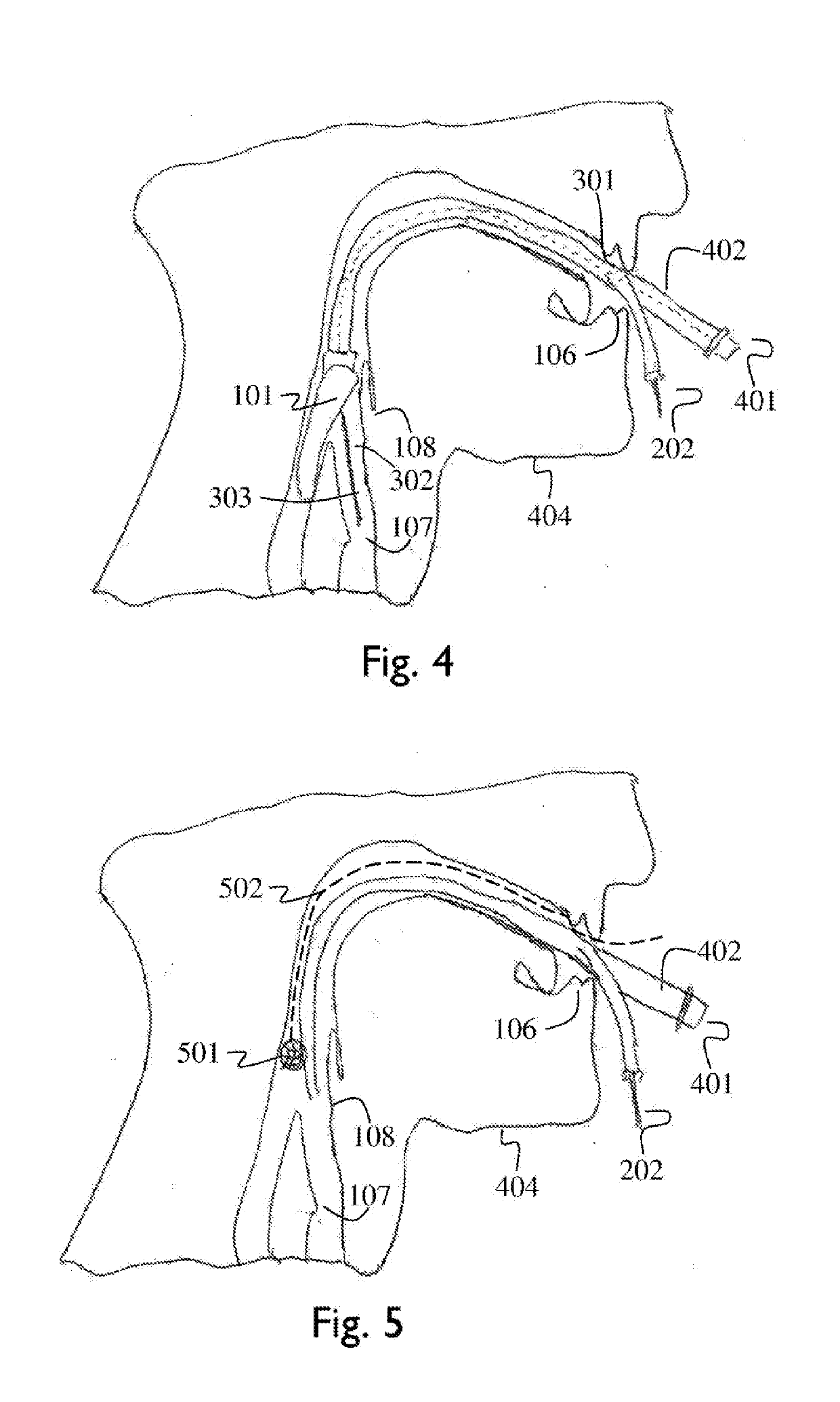 Laryngeal mask assembly