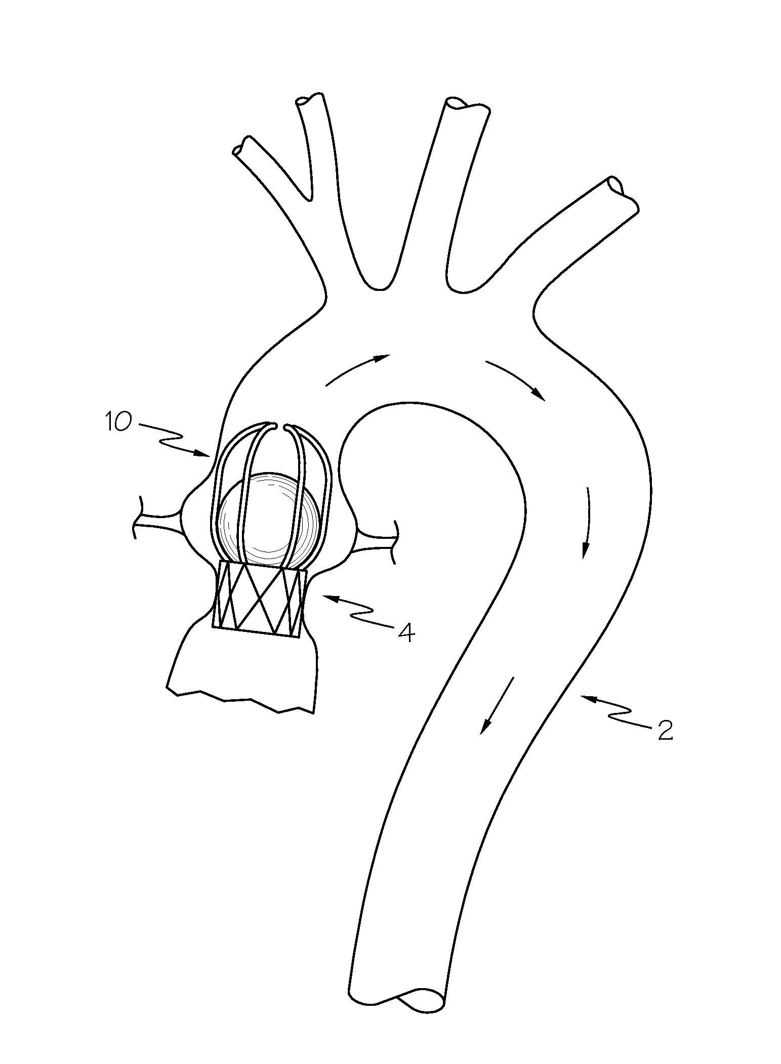 Collapsible caged-ball prosthetic  valve for transcatheter delivery and method of use