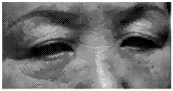 Hydrogel capable of eliminating eye bags and wrinkles and preparation method thereof