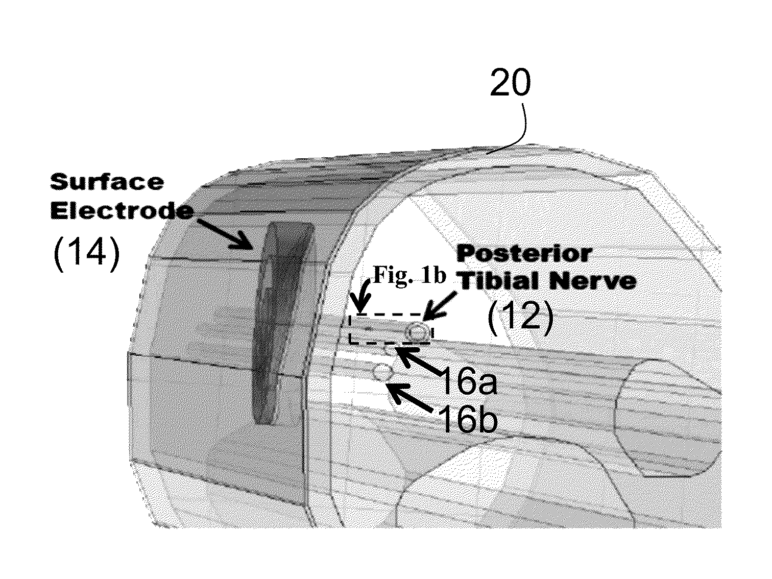 Systems and methods of enhancing electrical activation of nervous tissue