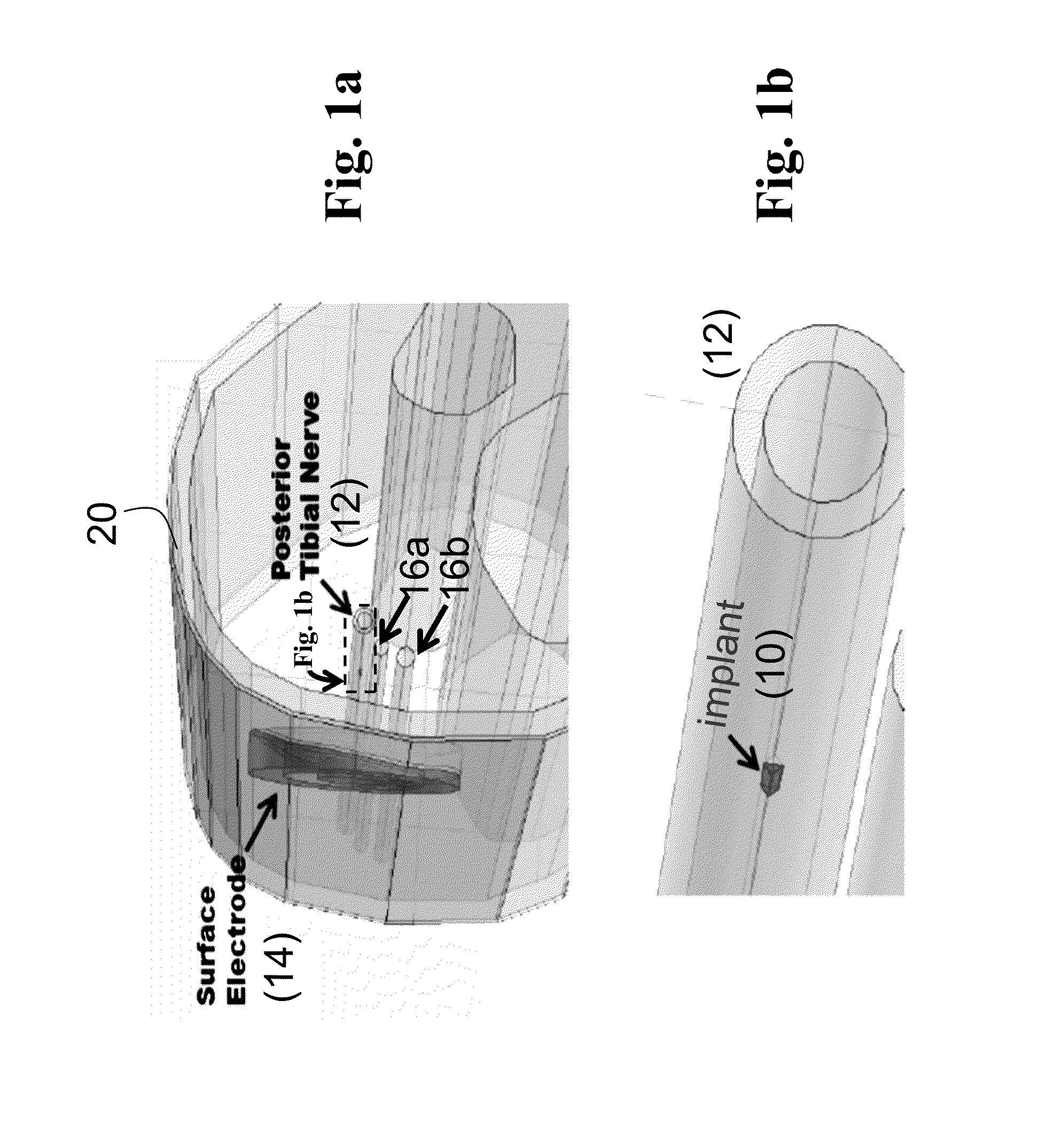 Systems and methods of enhancing electrical activation of nervous tissue