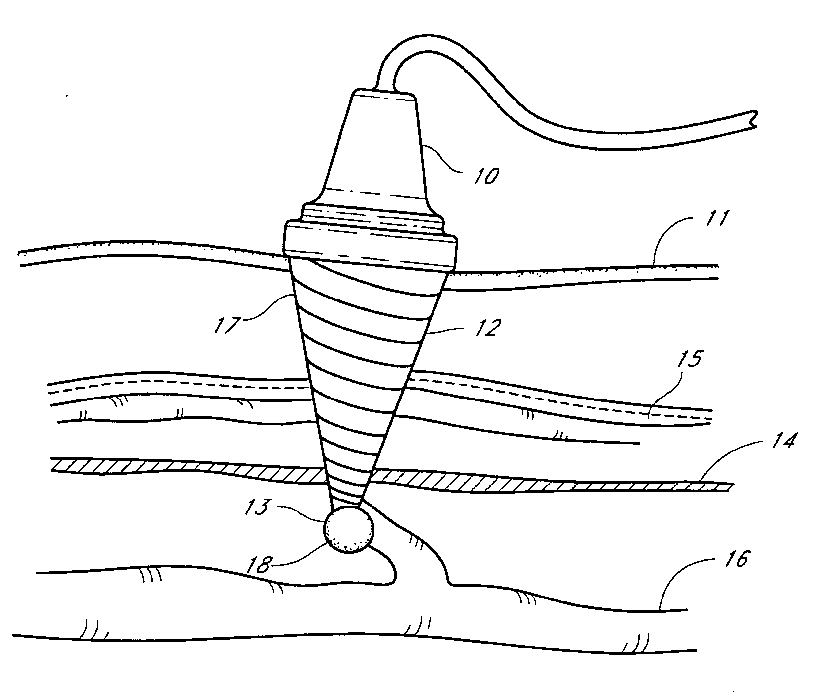 Method and apparatus for varicose vein treatment using acoustic hemostasis