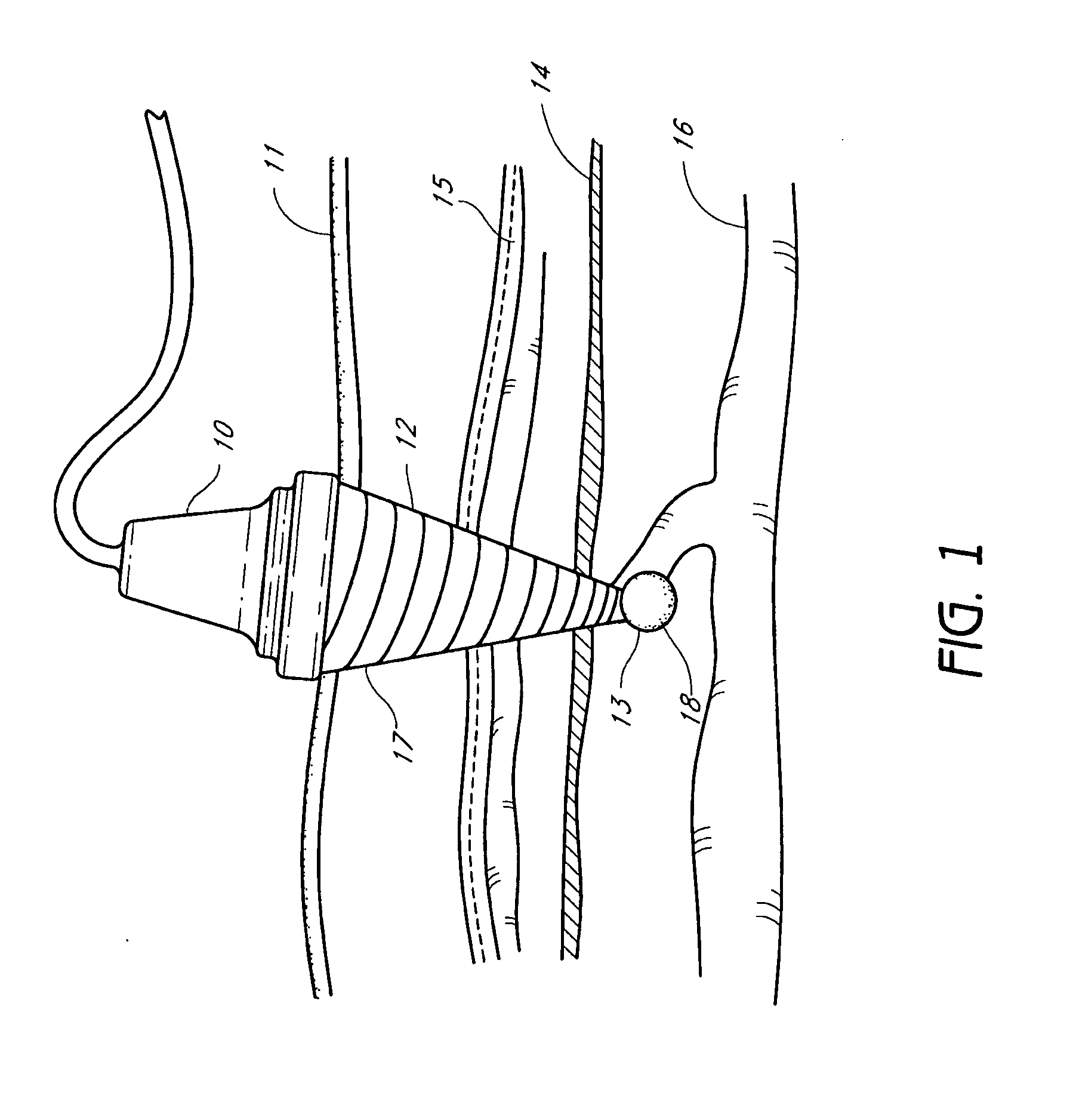 Method and apparatus for varicose vein treatment using acoustic hemostasis