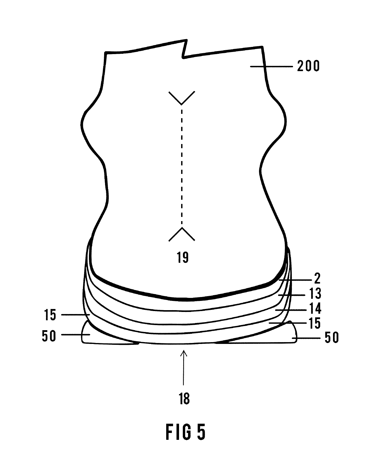 Custom multi-layered orthotic/orthosis, and method for forming