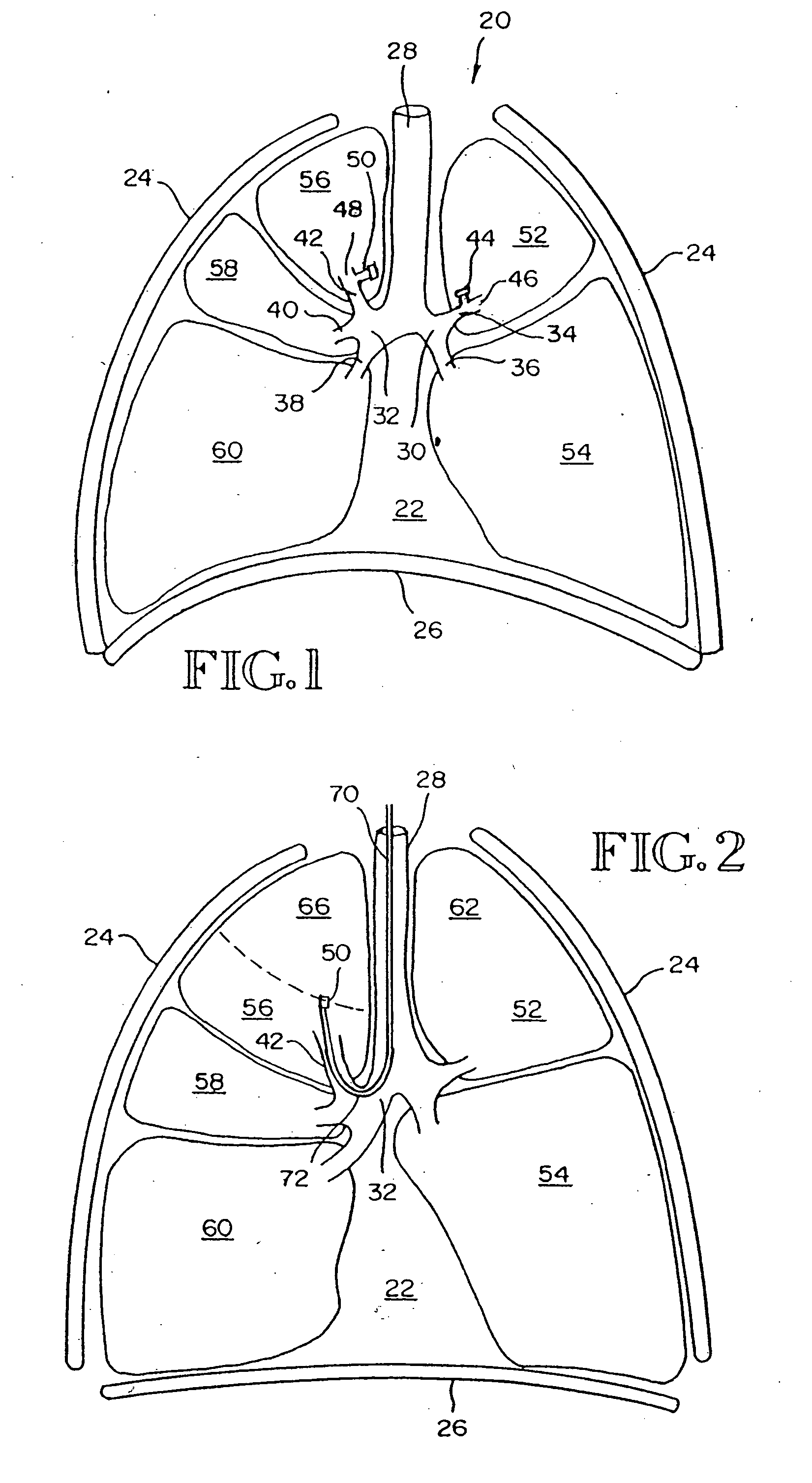 Intra-bronchial obstruction device that provides a medicant intra-bronchially to the patient