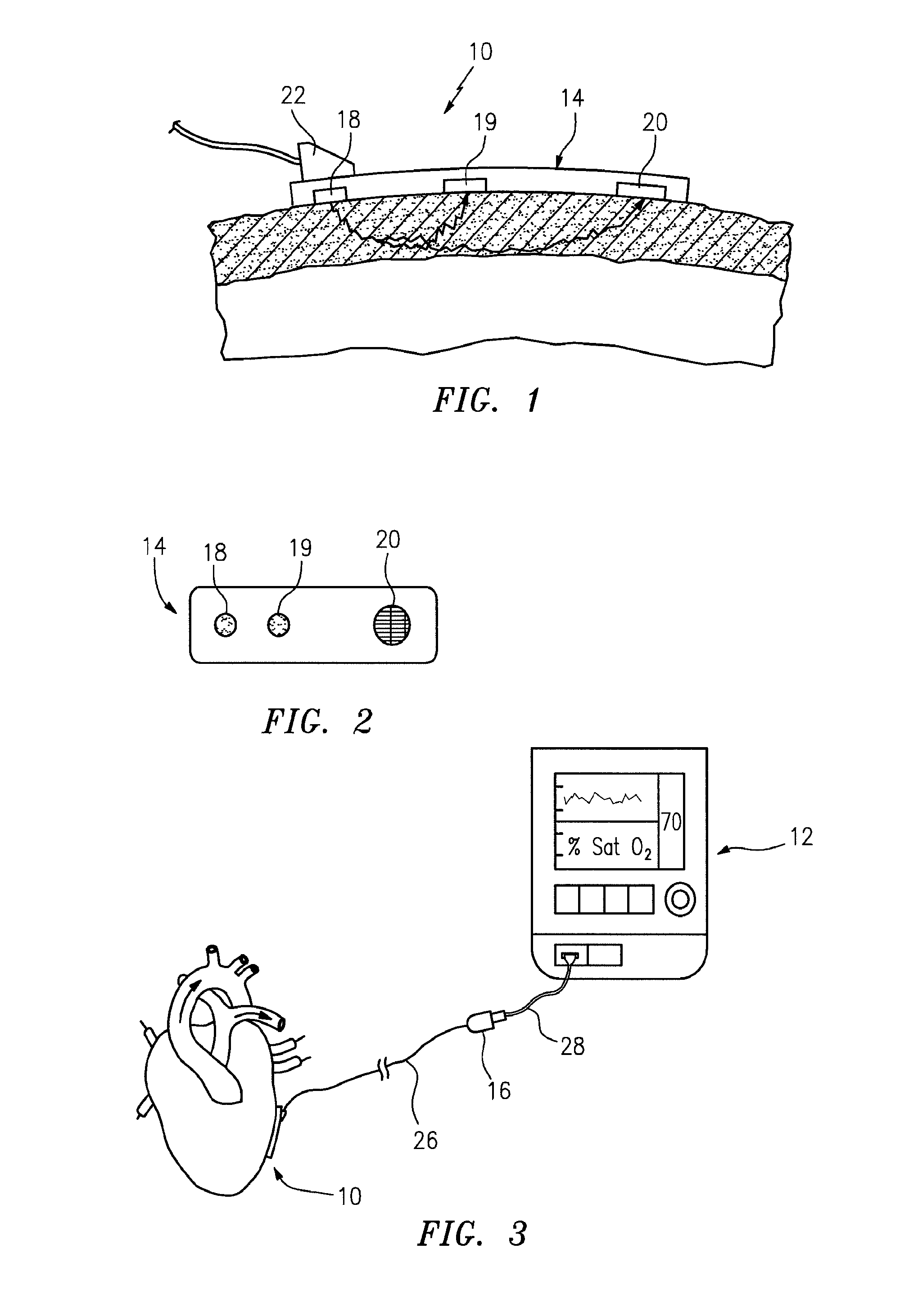 Method for spectrophotometric blood oxygenation monitoring of organs in the body