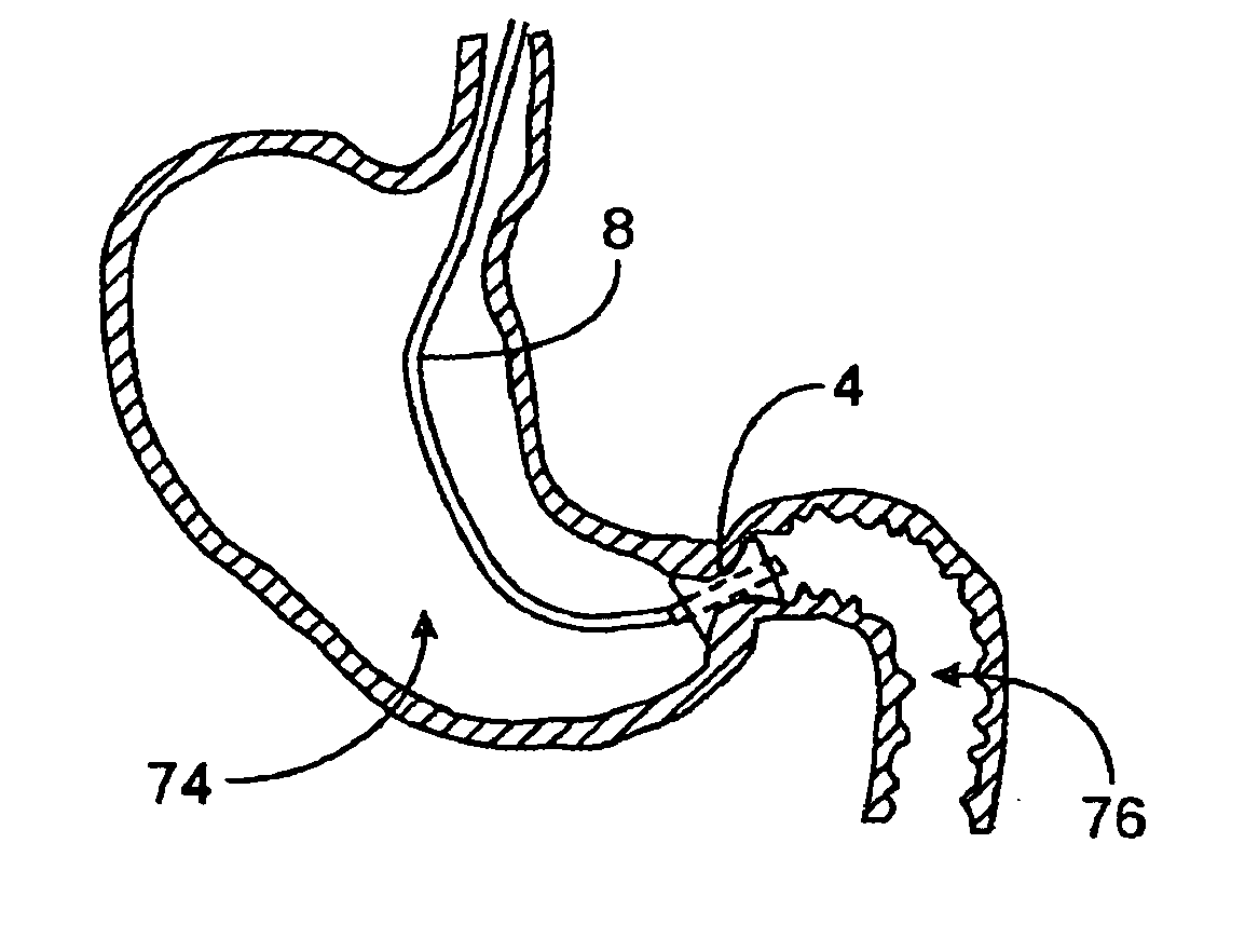 Pyloric valve corking device