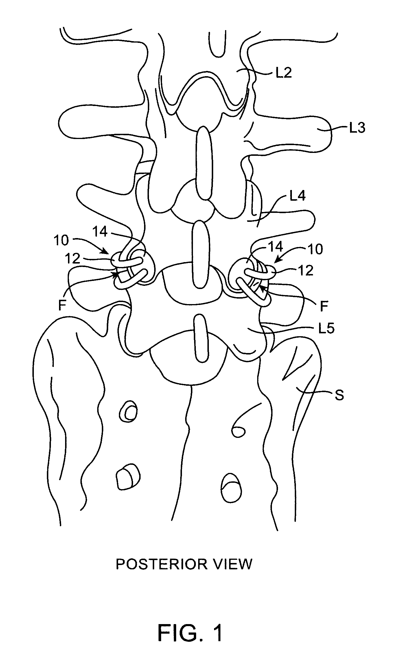 Facet joint fusion devices and methods