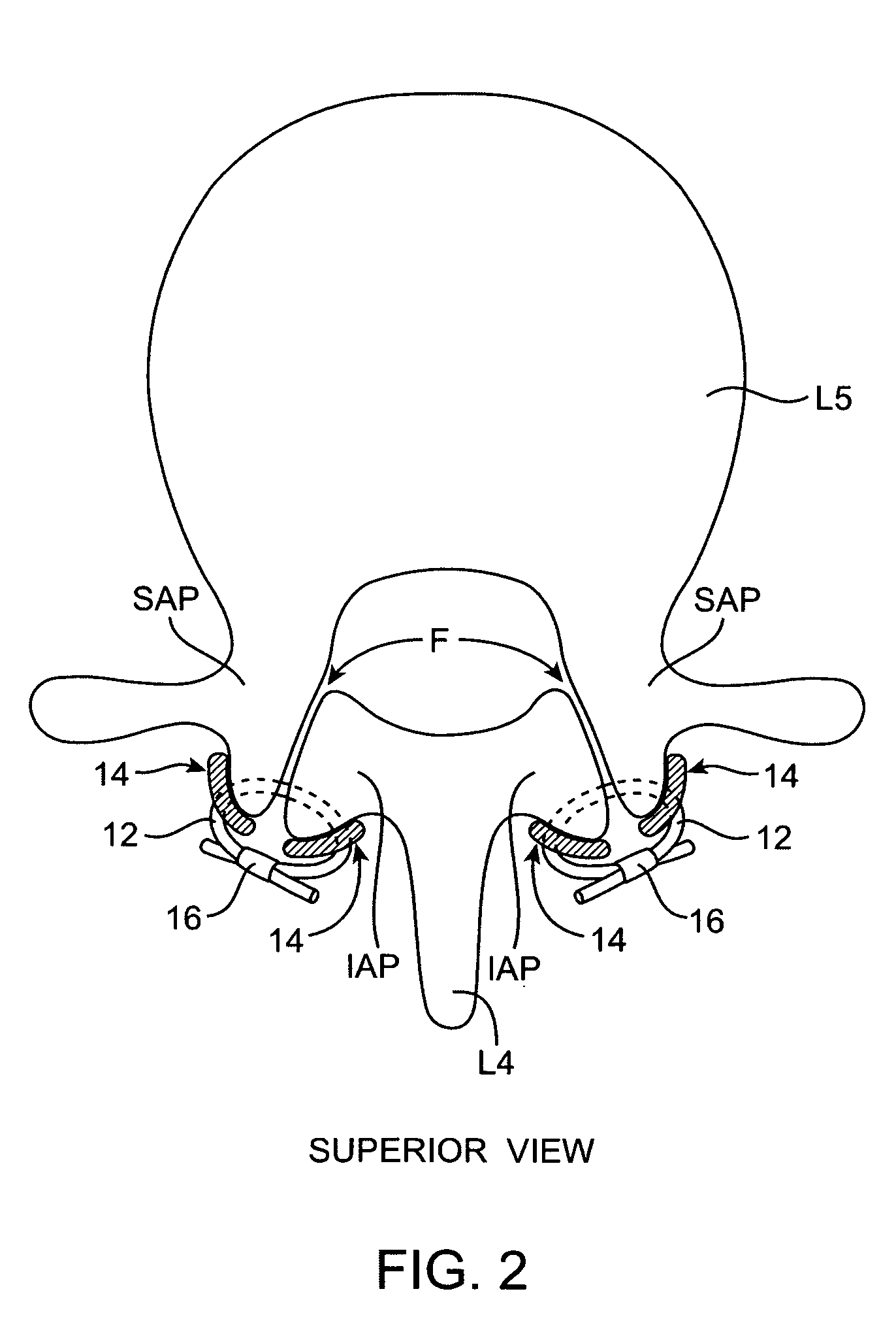 Facet joint fusion devices and methods