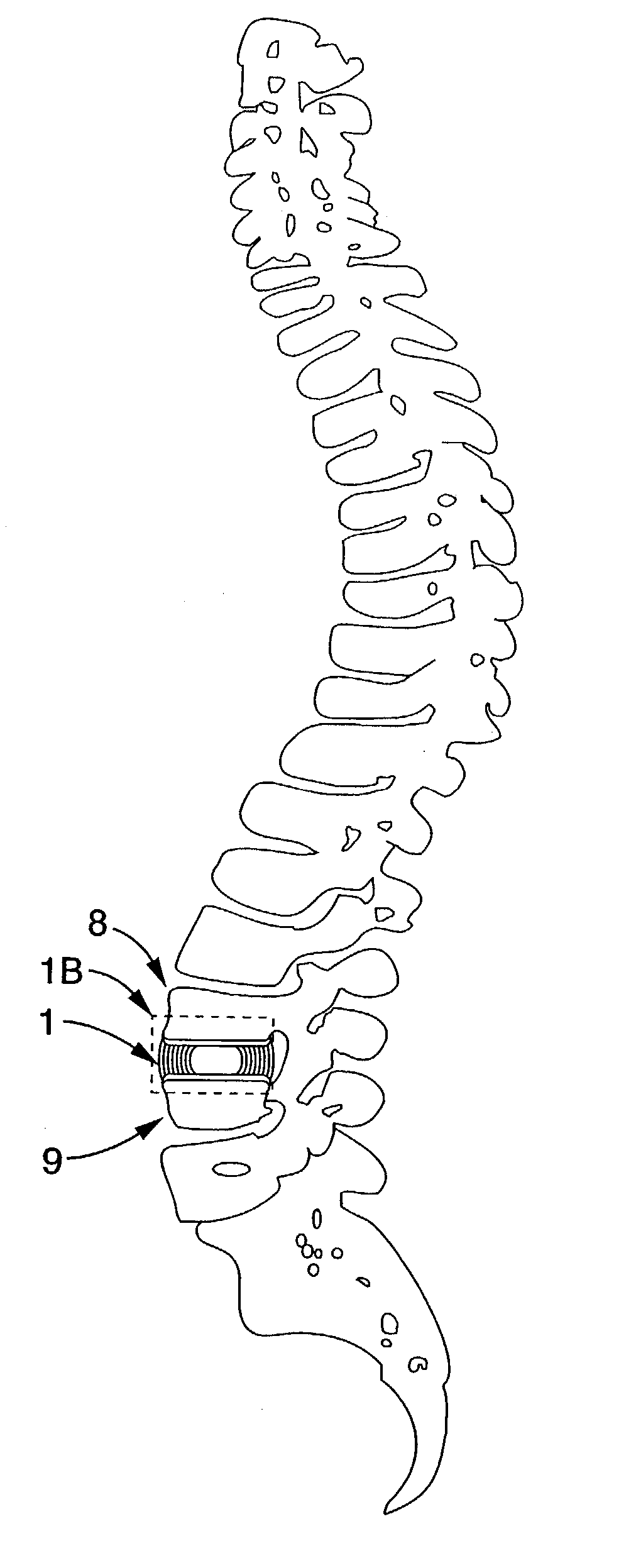 Implantable thermal treatment method and apparatus