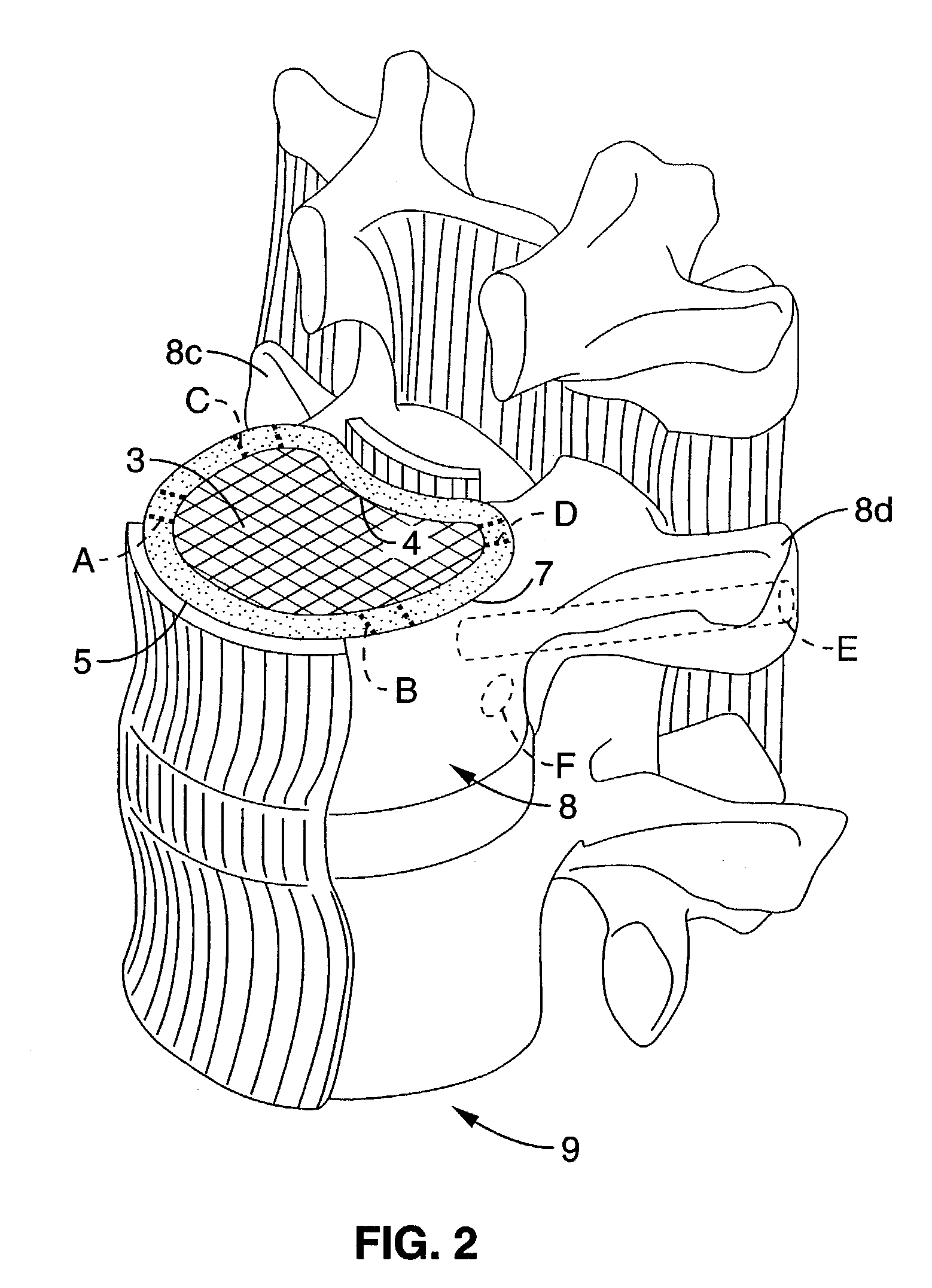 Implantable thermal treatment method and apparatus