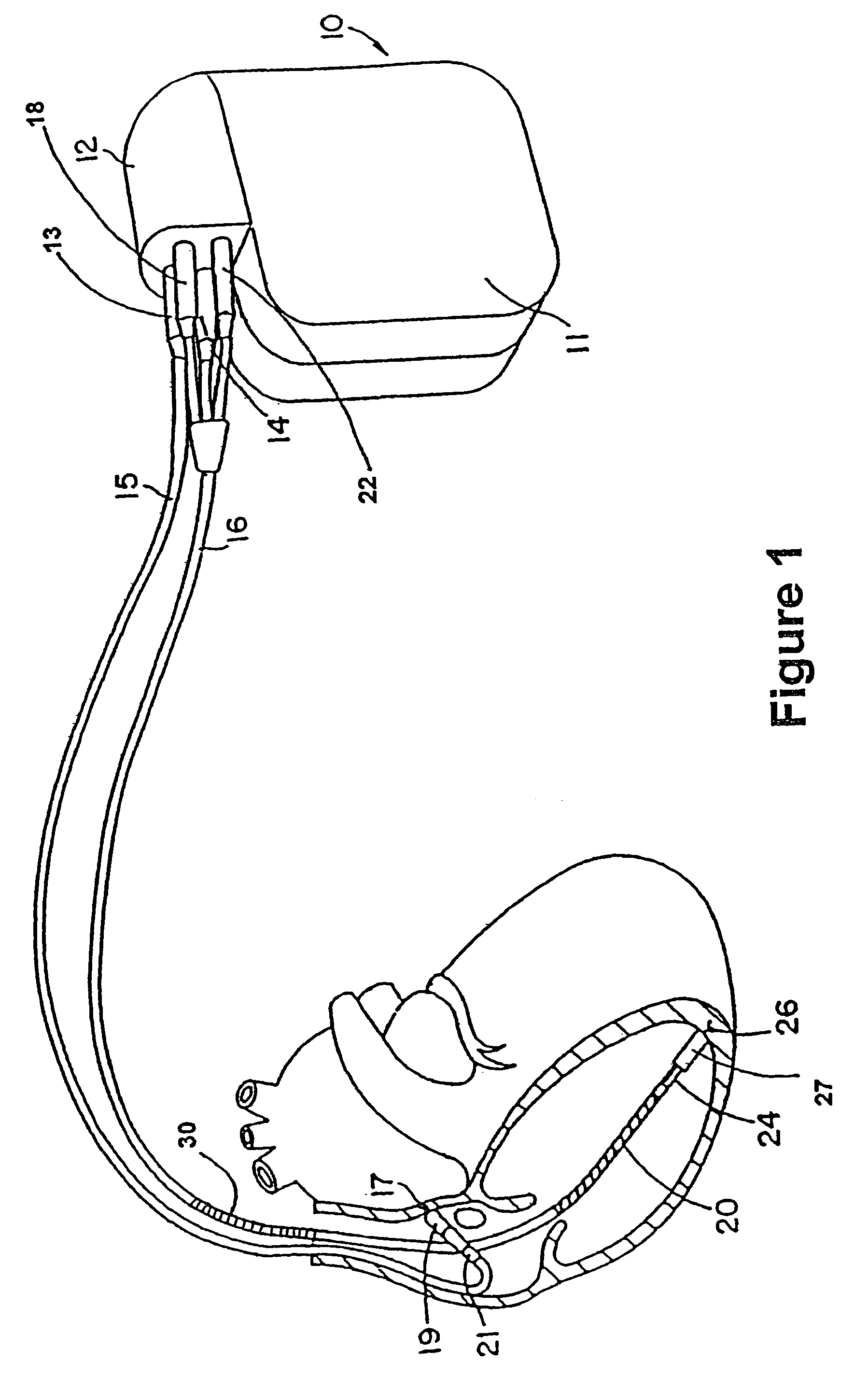 Implantable medical device with sleep disordered breathing monitoring