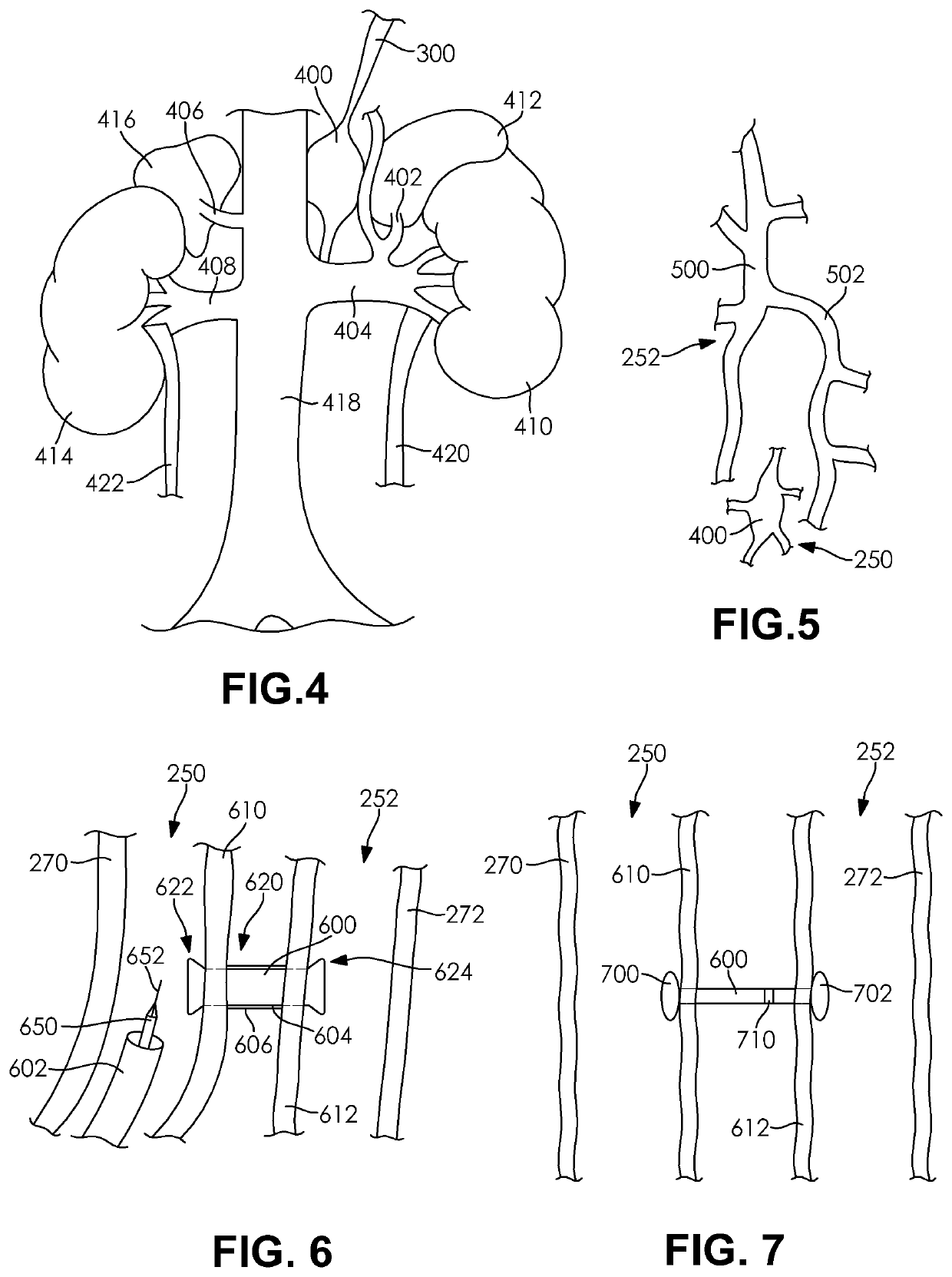 Devices and Methods for Treating Congestive Heart Failure, Ascites, and Other Disorders Relating to Excess Bodily Fluid