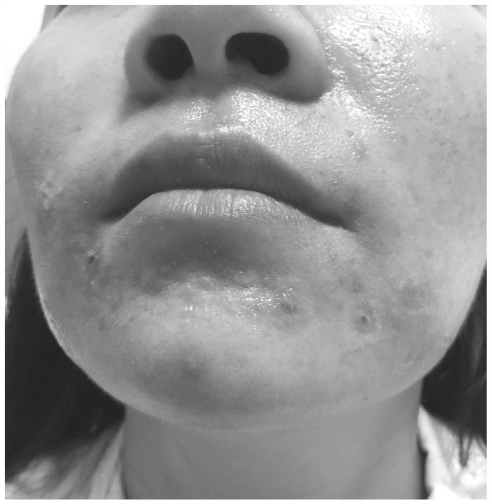 A kind of traditional Chinese medicine composition for treating acne