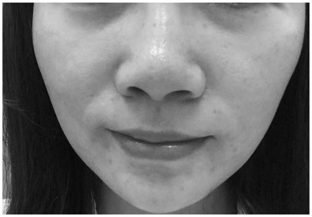 A kind of traditional Chinese medicine composition for treating acne