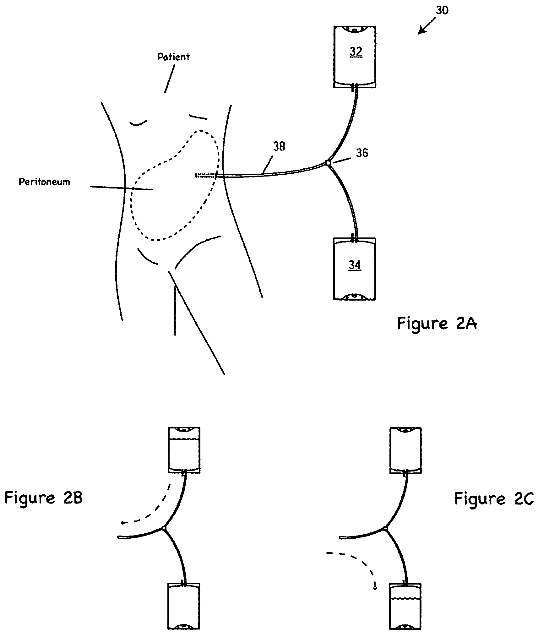 Apparatus and methods for early stage peritonitis detection including self-cleaning effluent chamber