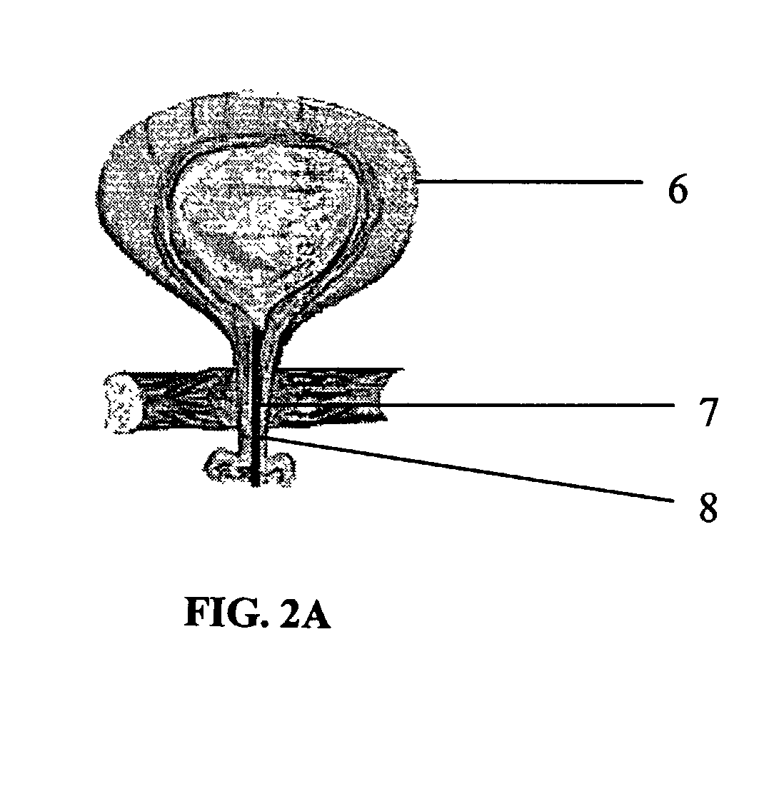 Biodegradable injectable implants containing glycolic acid