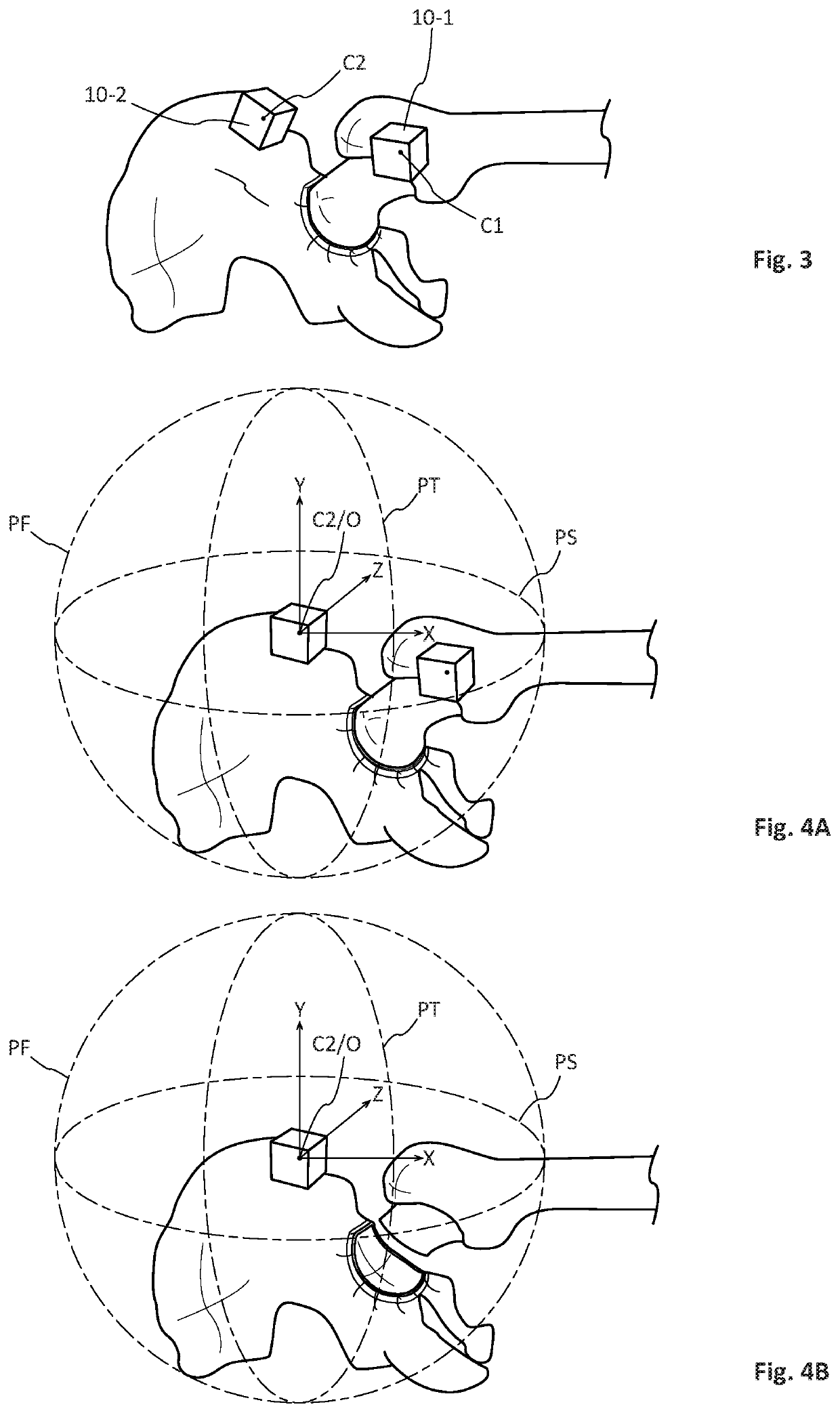 Method and device for assisting a surgeon fit a prosthesis, in particular a hip prosthesis, following different surgical protocols