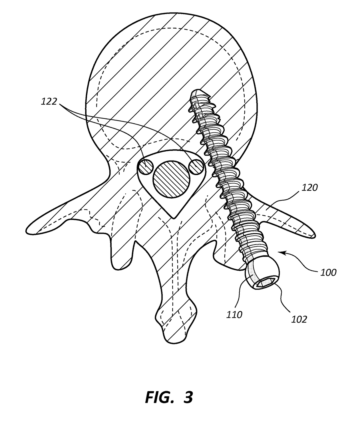 Pedicle screw with electro-conductive coating or portion