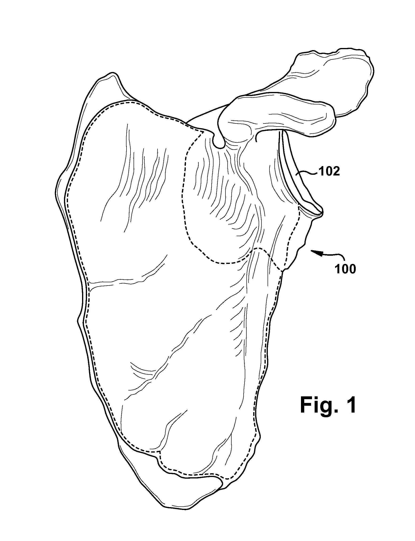 System and method for association of a guiding aid with a patient tissue
