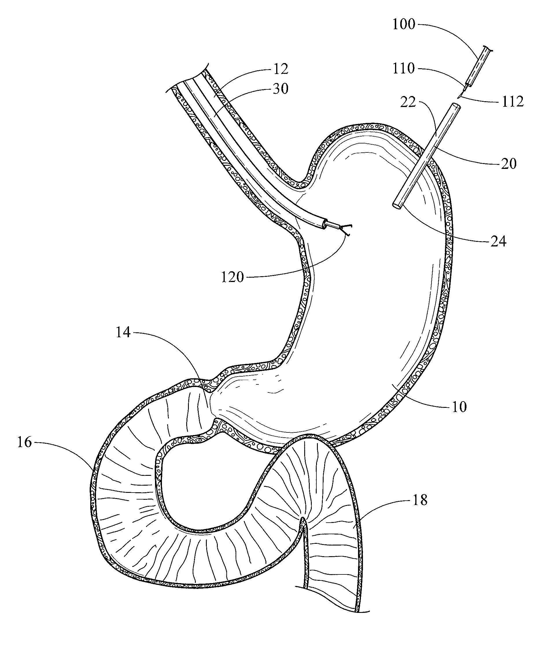 Device, kit and method for placing jejunal tube device through stomach and into small intestine