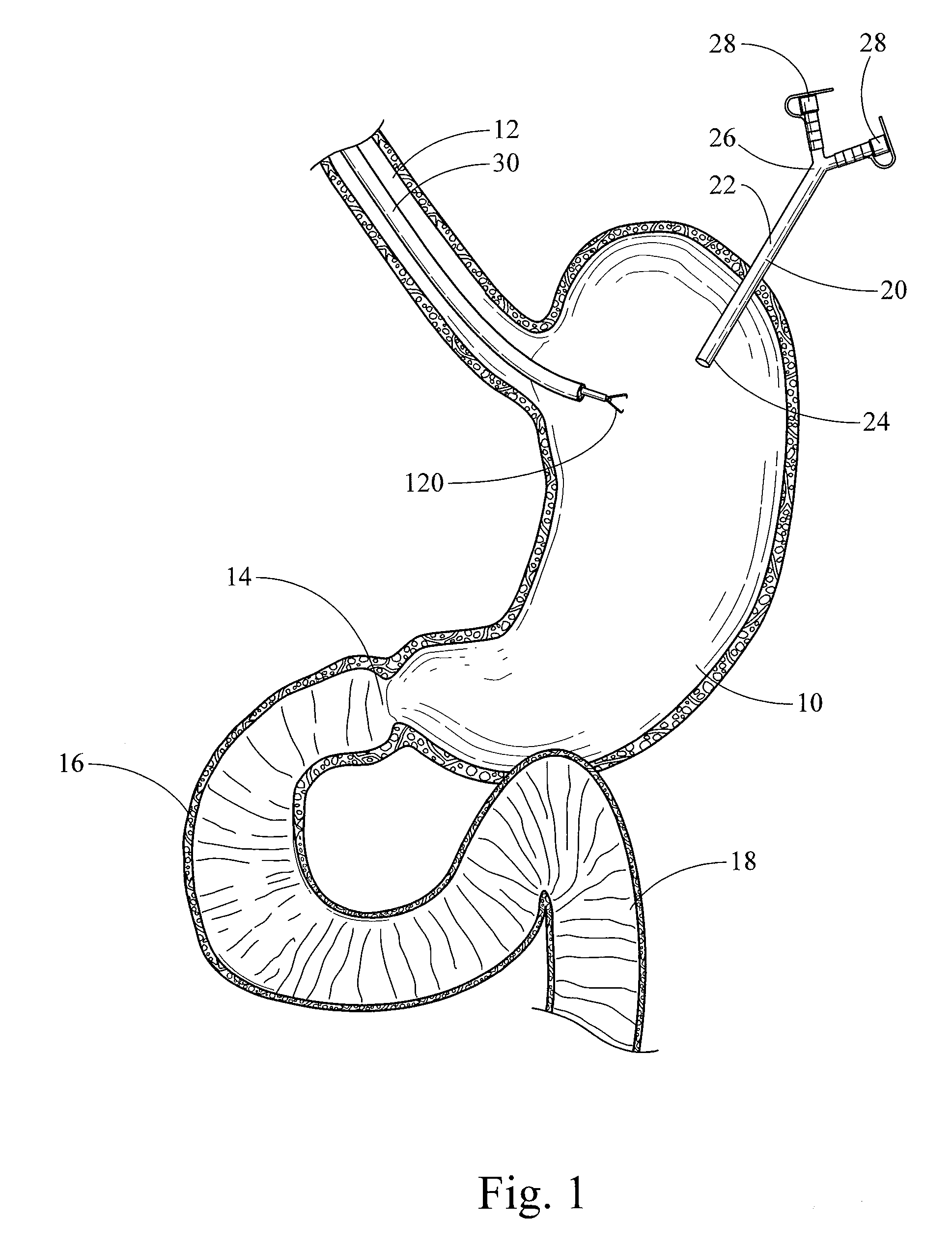 Device, kit and method for placing jejunal tube device through stomach and into small intestine