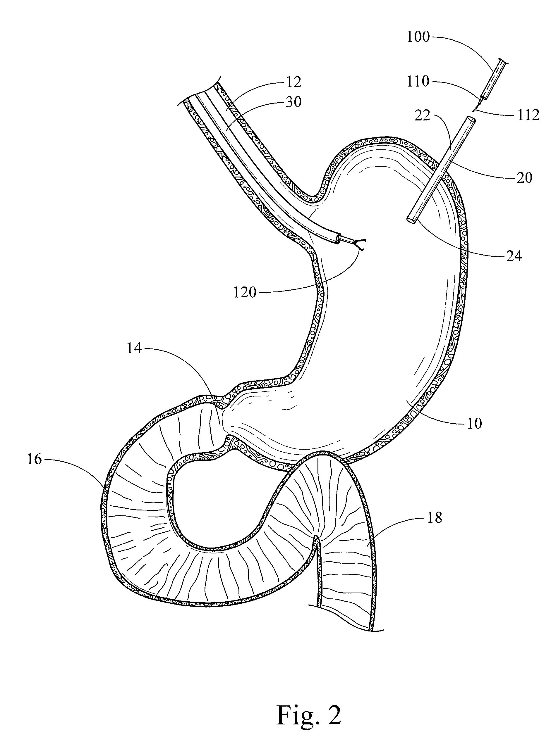 Device, kit and method for placing jejunal tube device through stomach and into small intestine