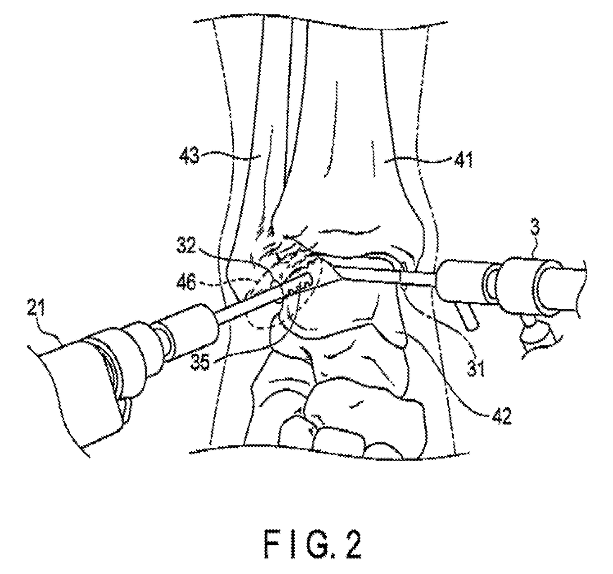 Arthroscopic surgery method for ankle ligament reconstruction