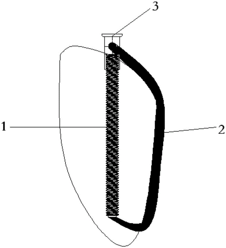 Patella locking compression internal fixation device