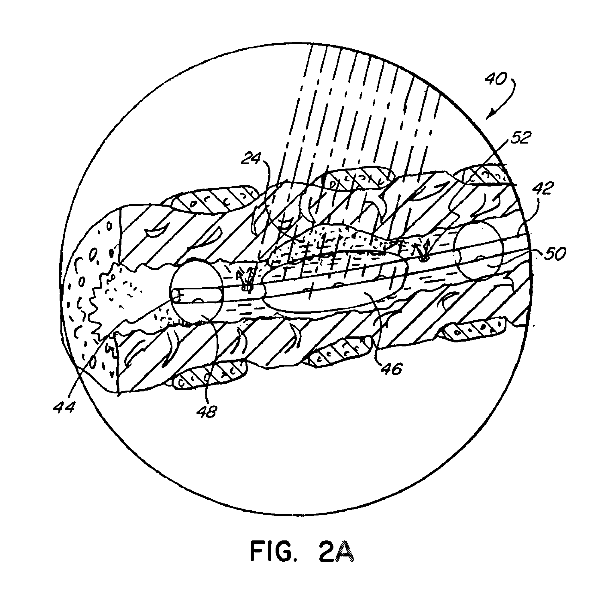 Photodynamic Therapy for Tumors With Localized Delivery