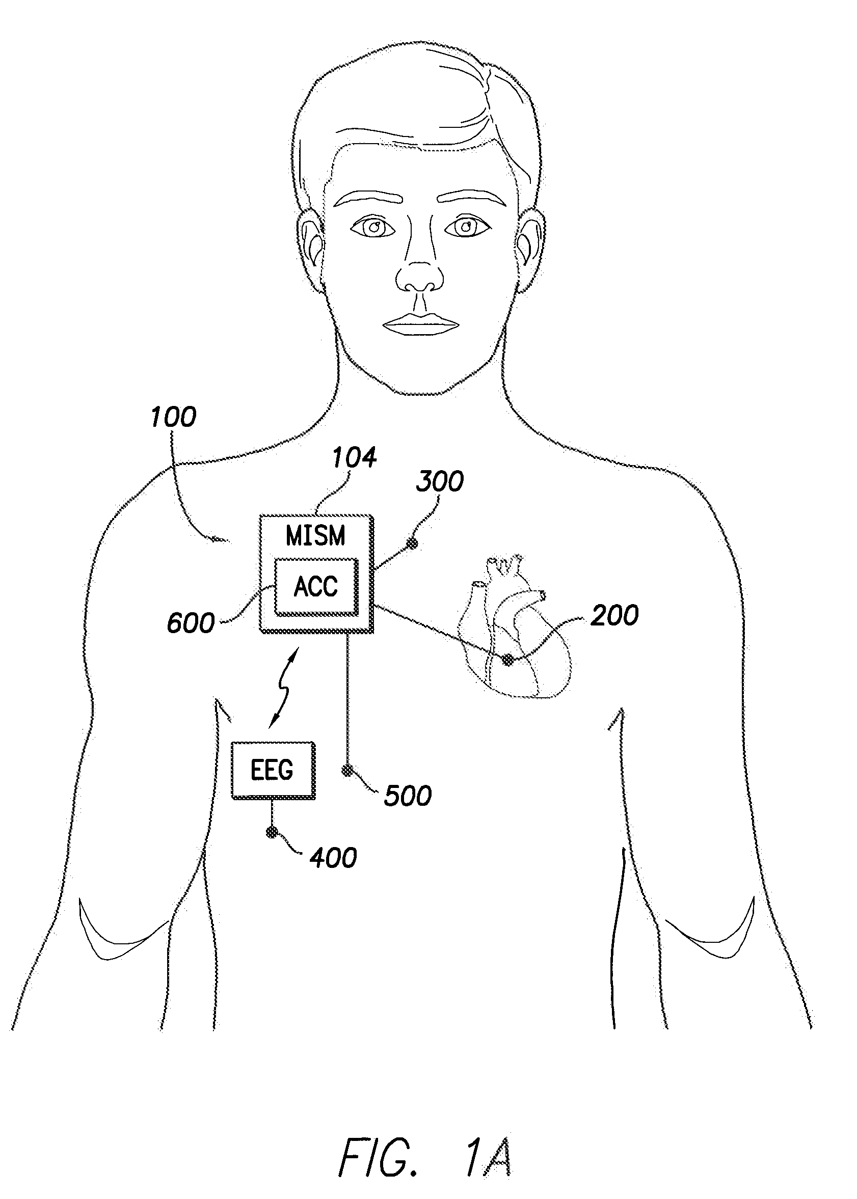 Multifaceted implantable syncope monitor - mism