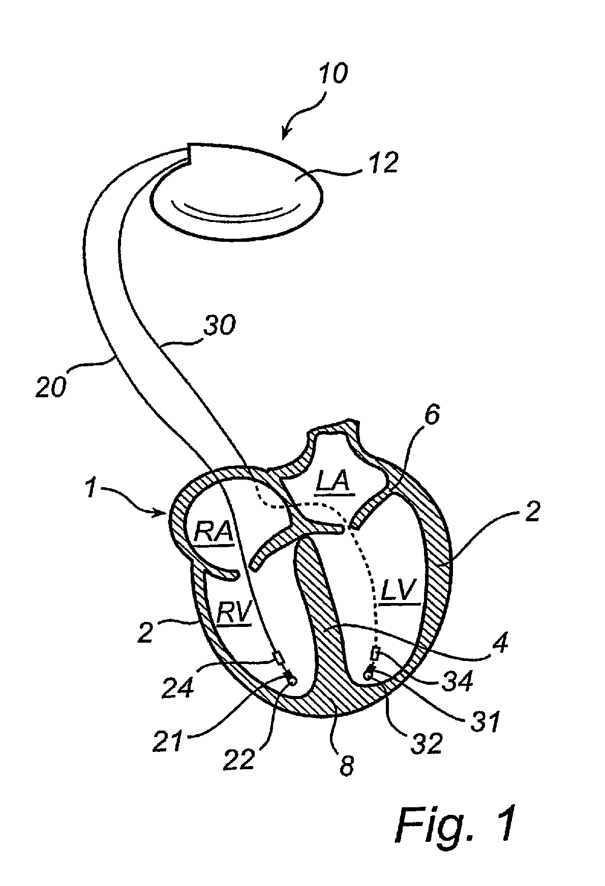 Implantable cardiac stimulator, system, device and method for monitoring cardiac synchrony