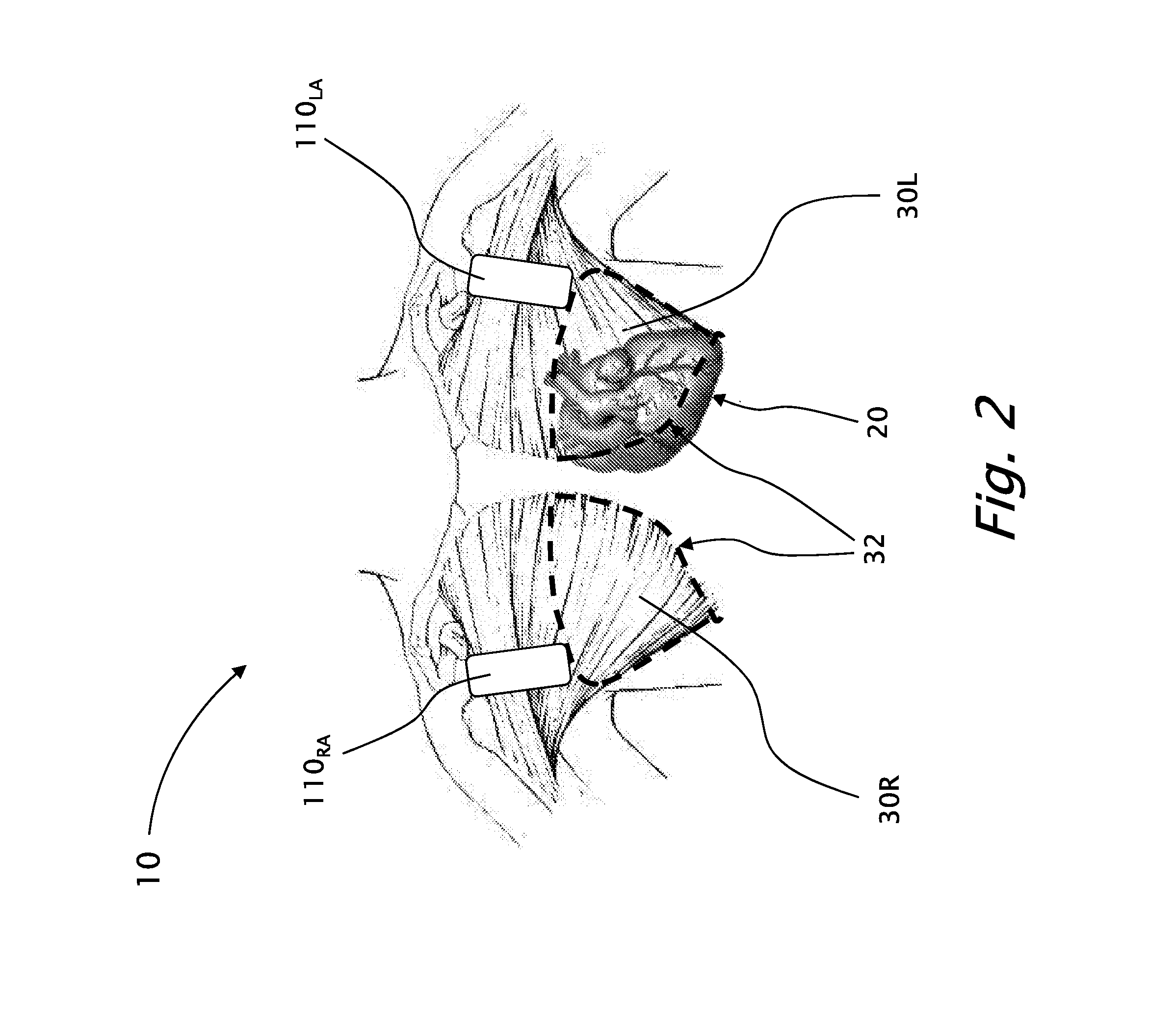 Devices and methods for obtaining workable ECG signals using dry knitted electrodes