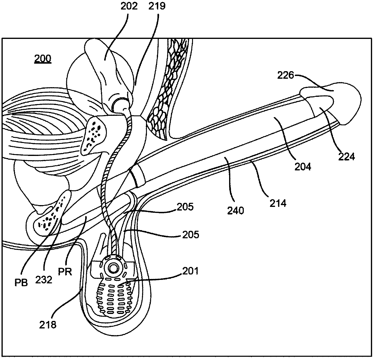 Inflatable penile prosthesis with reversible flow pump