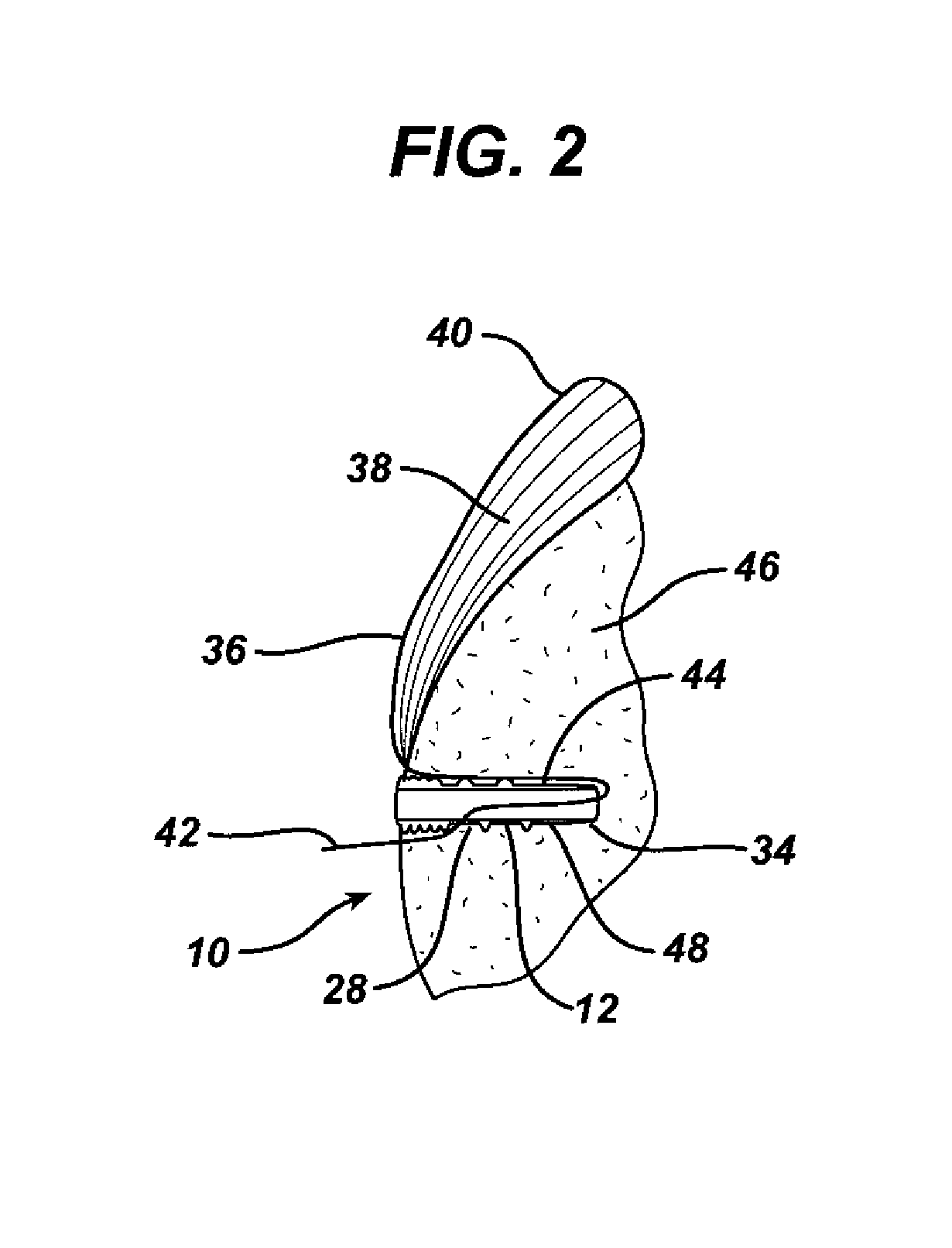 Knotless suture anchor with unthreaded nose