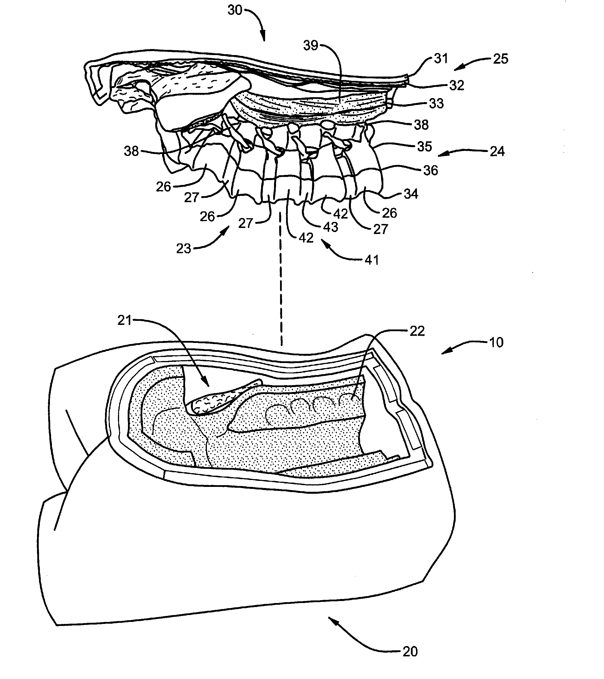 Surgical training model and method for use in facilitating training of a surgical procedure