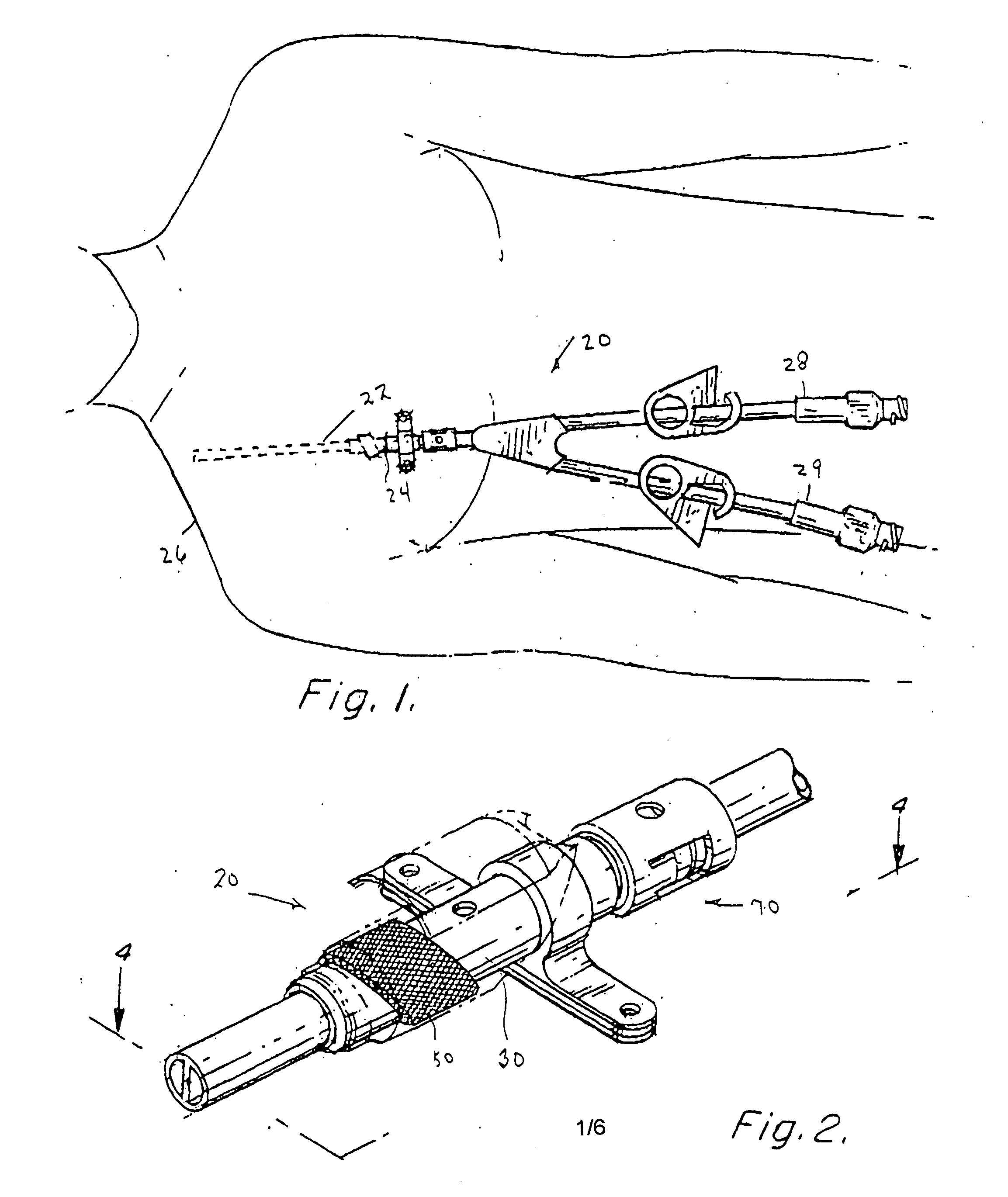 Apparatus and method for facilitating the replacement of an implanted catheter