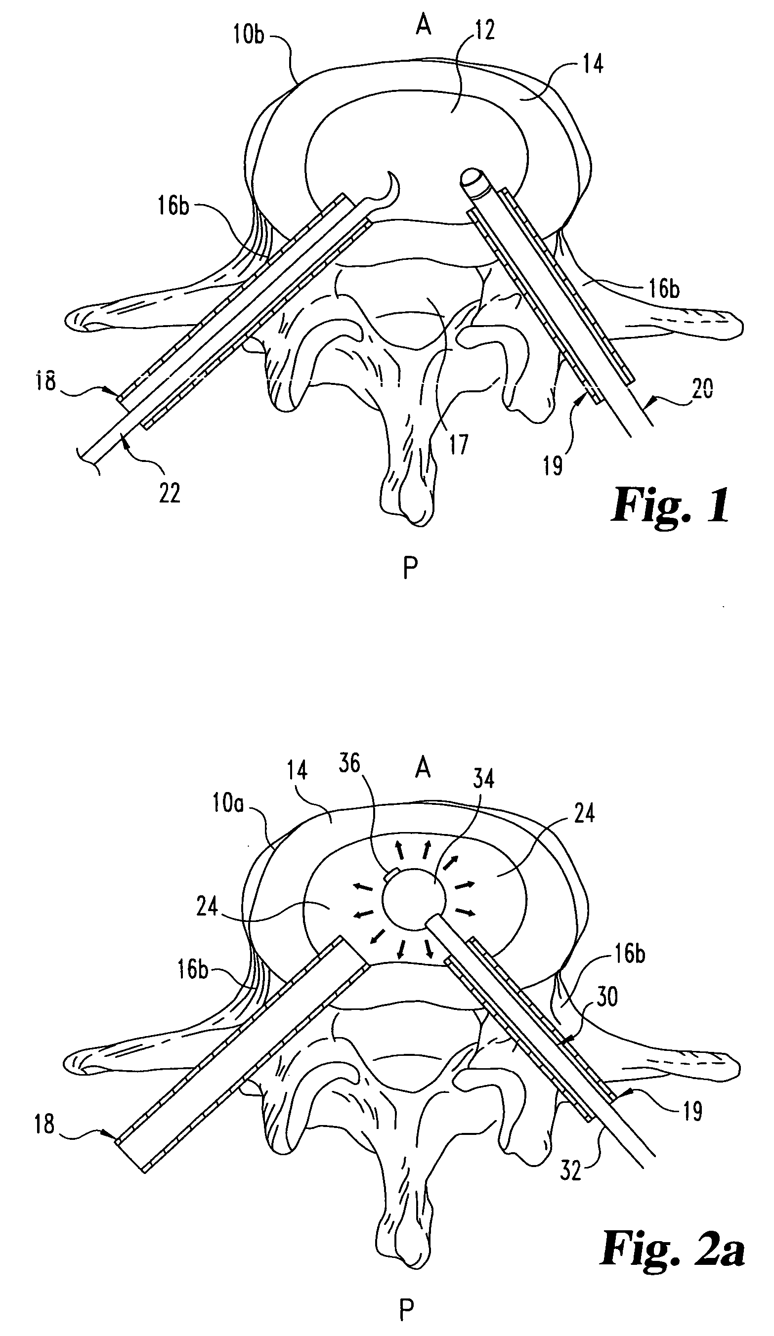 Methods and devices for interbody spinal stabilization